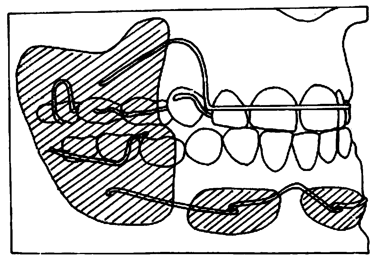 Oral function appliance
