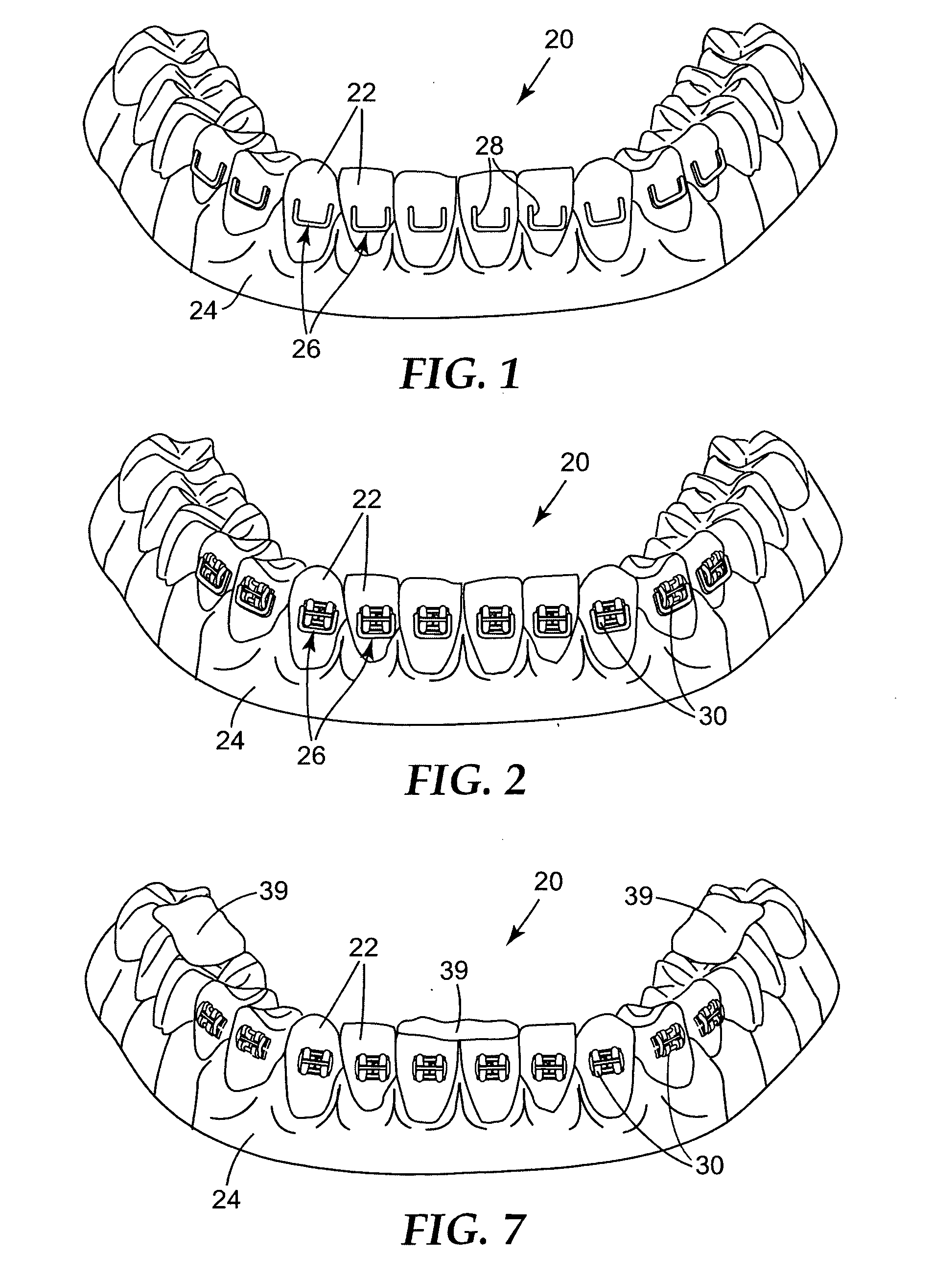 Method of making an indirect bonding tray for orthodontic treatment