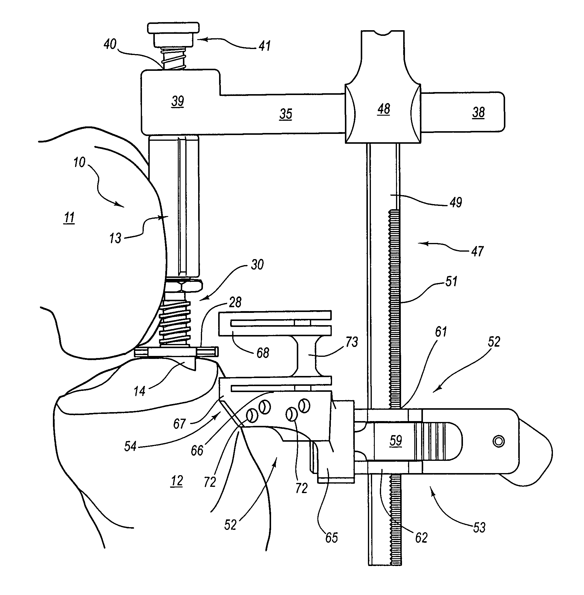 Guide assembly for guiding cuts to a femur and tibia during a knee arthroplasty