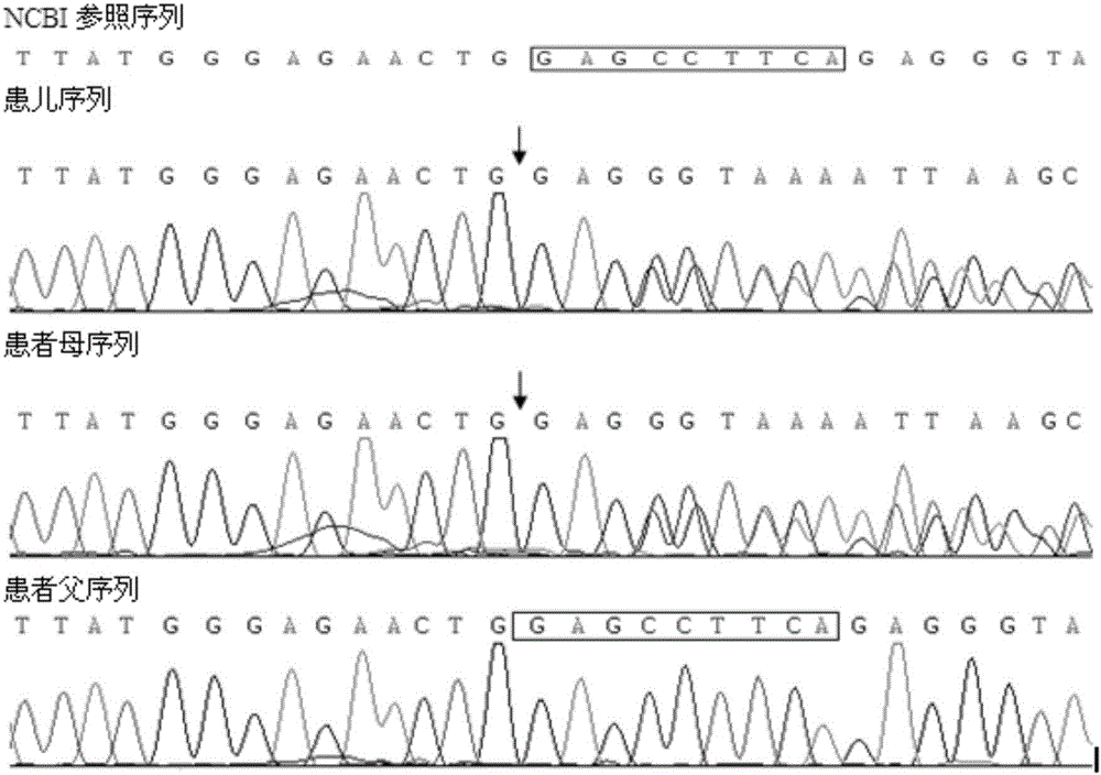 CFTR (Cystic Fibrosis Transmembrane Conductance Regulator) gene deletion mutation form of cystic fibrosis patients and application of CFTR gene deletion mutation form