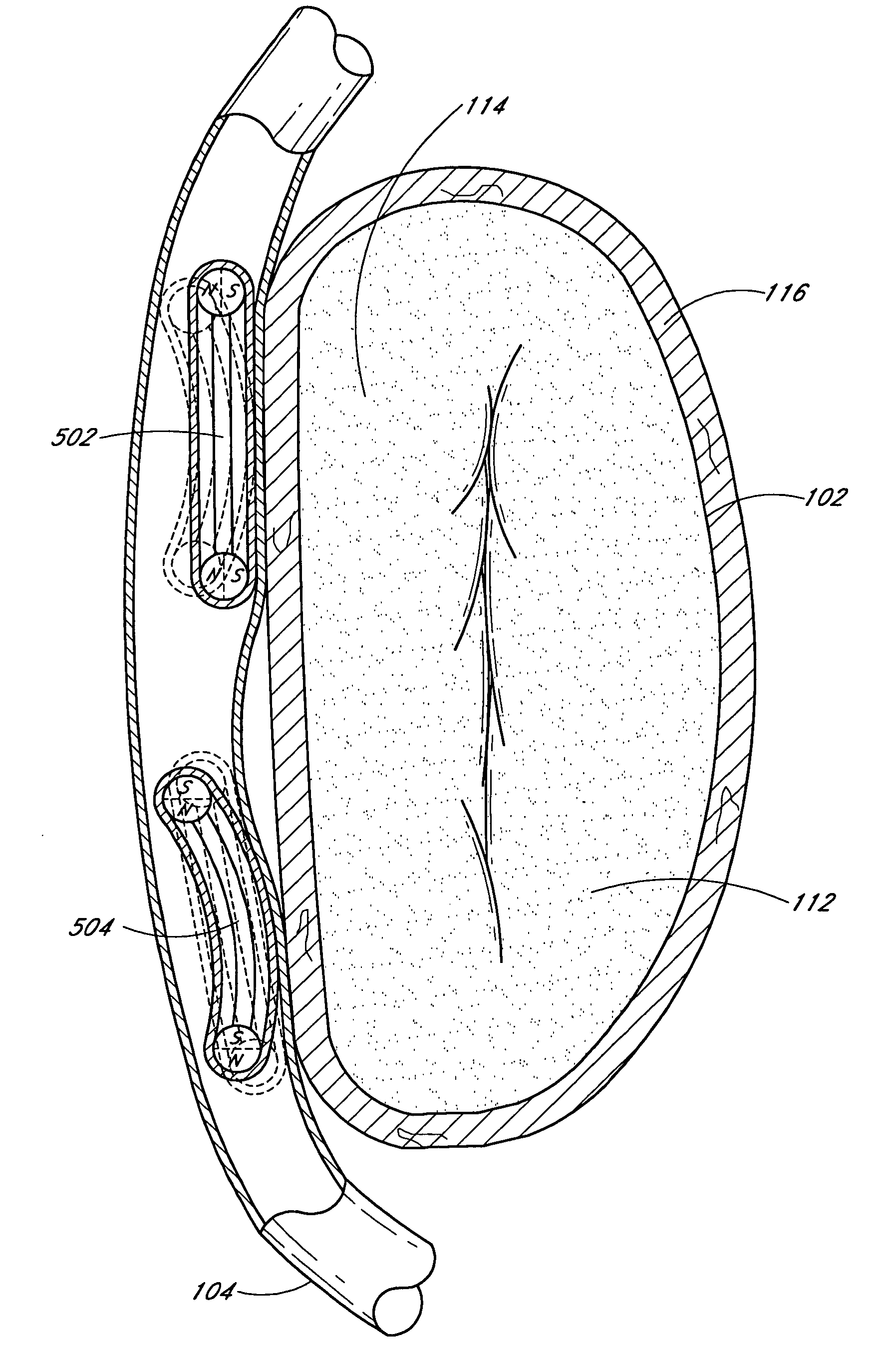 Magnetic implants and methods for reshaping tissue