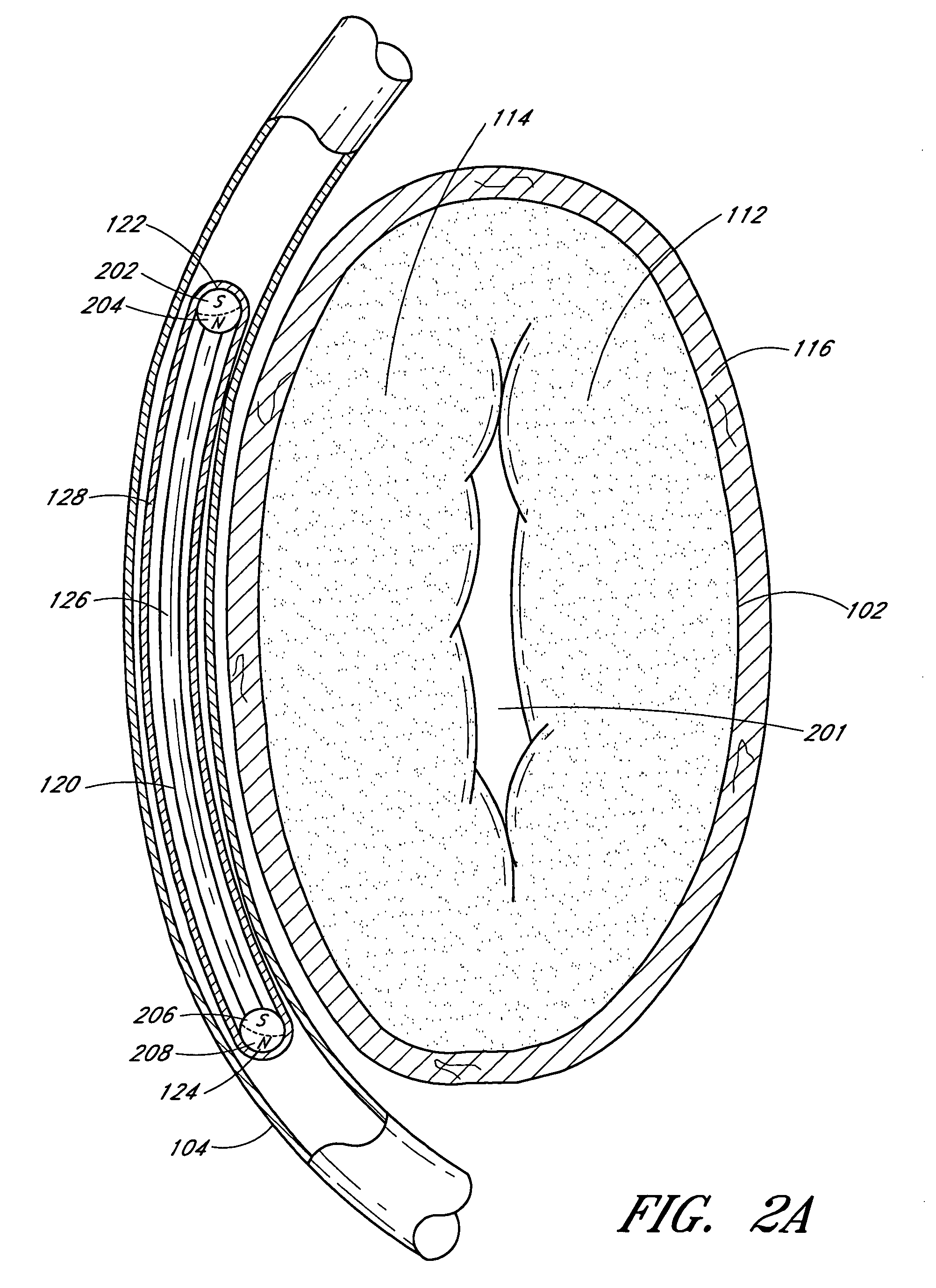Magnetic implants and methods for reshaping tissue
