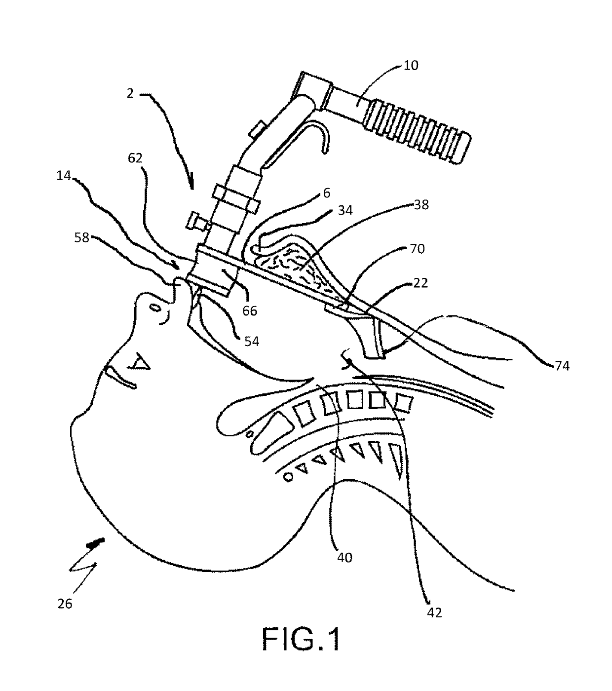 Retractor and tip extender therefor