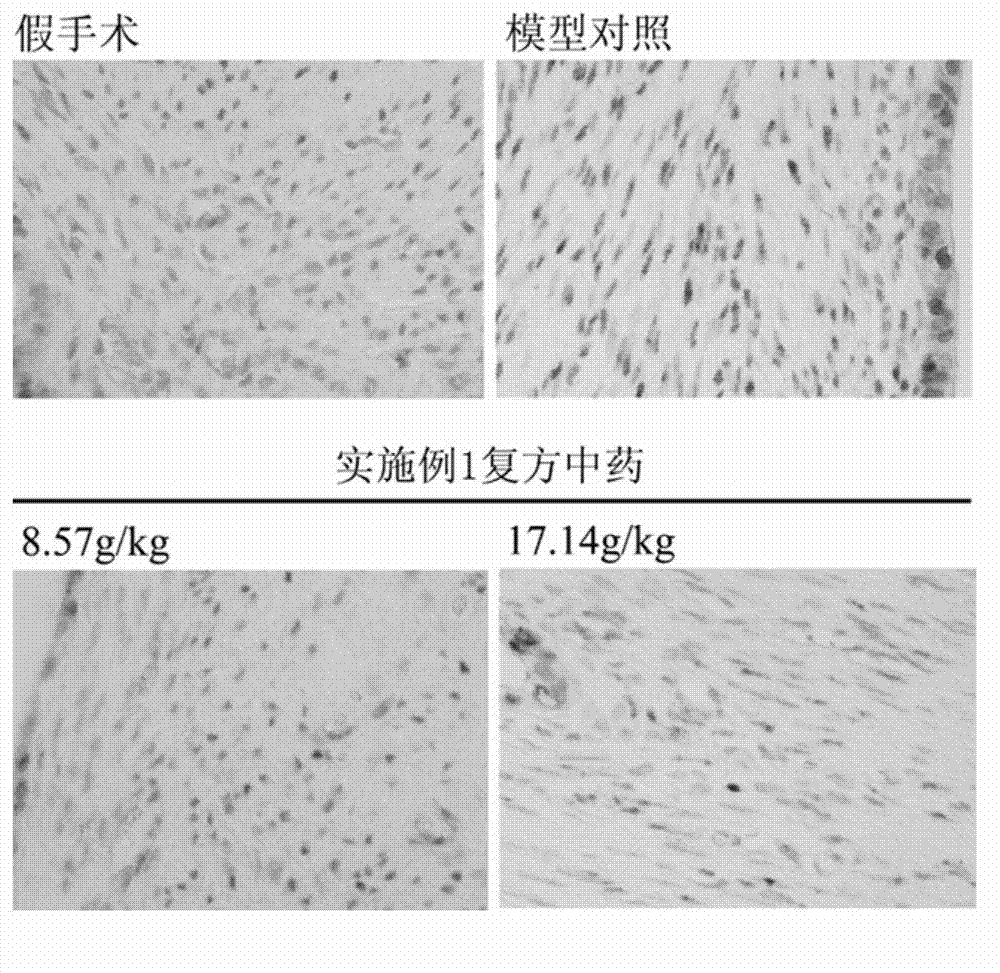 Compound traditional Chinese medicine for treating endometriosis and preparation method and application thereof
