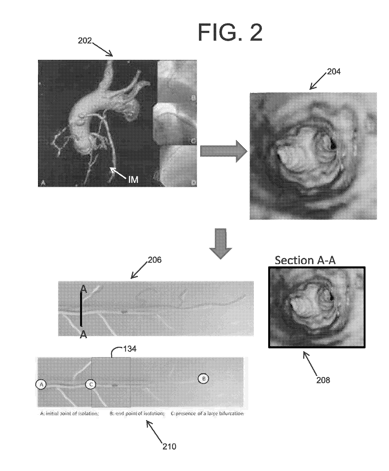 Spatial visualization of internal mammary artery during minimally invasive bypass surgery