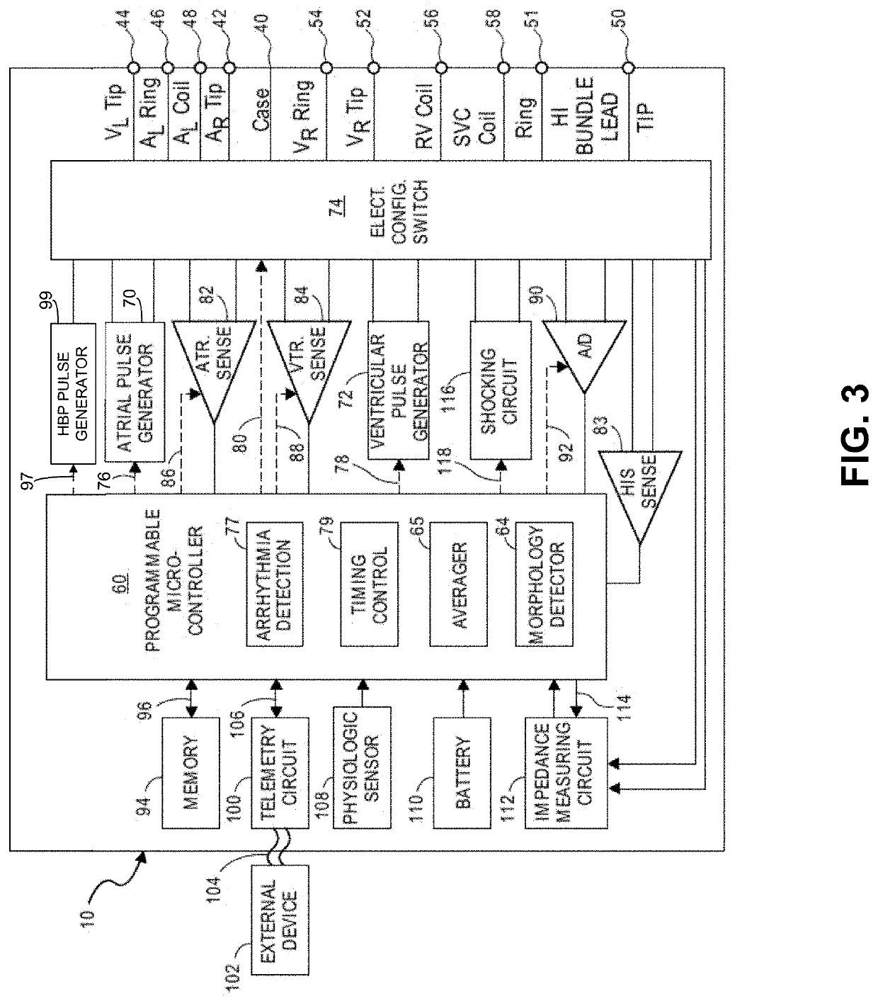 Time domain-based methods for his bundle capture classification