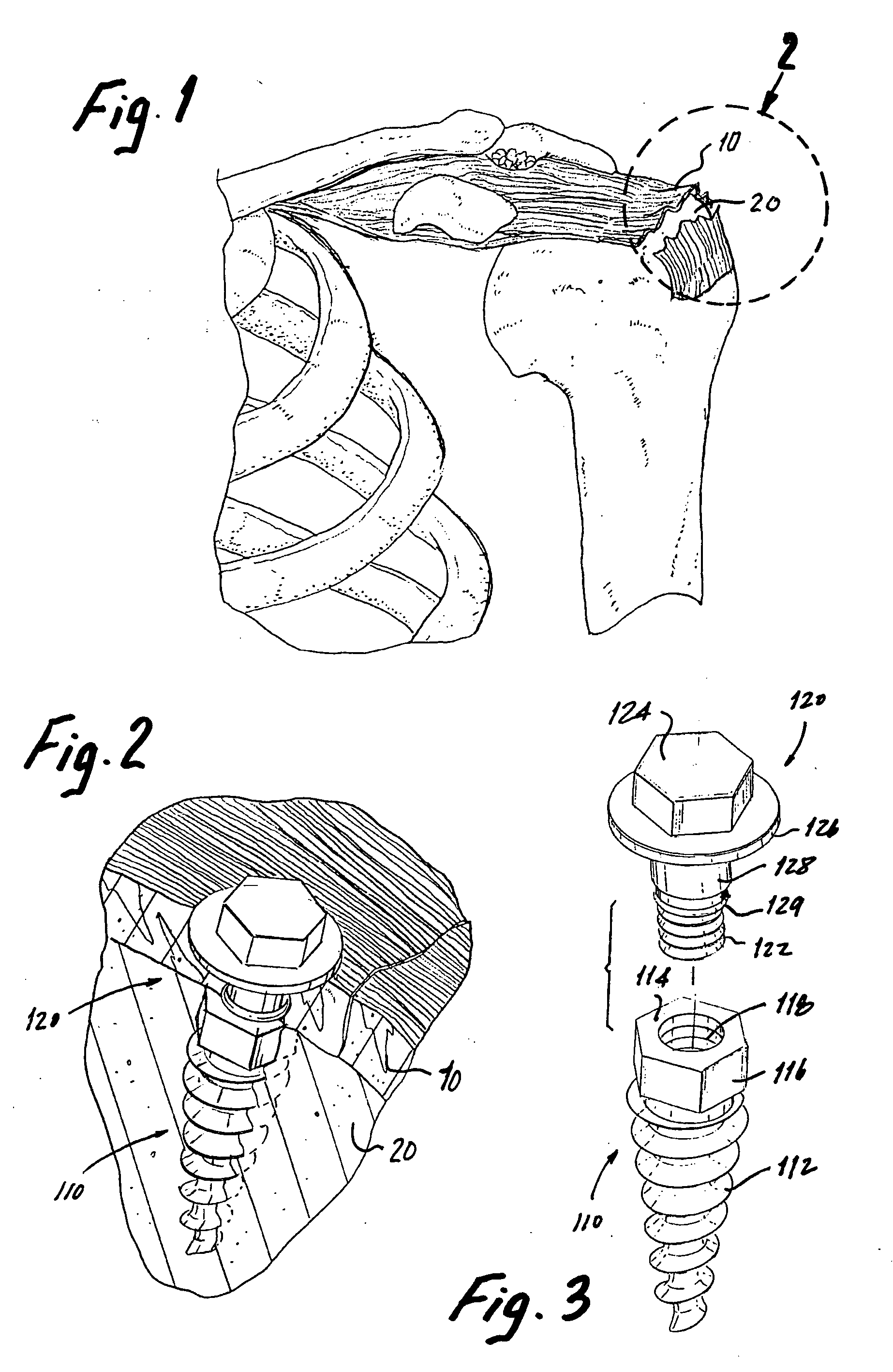 Apparatus and method for attaching connective tissue to bone
