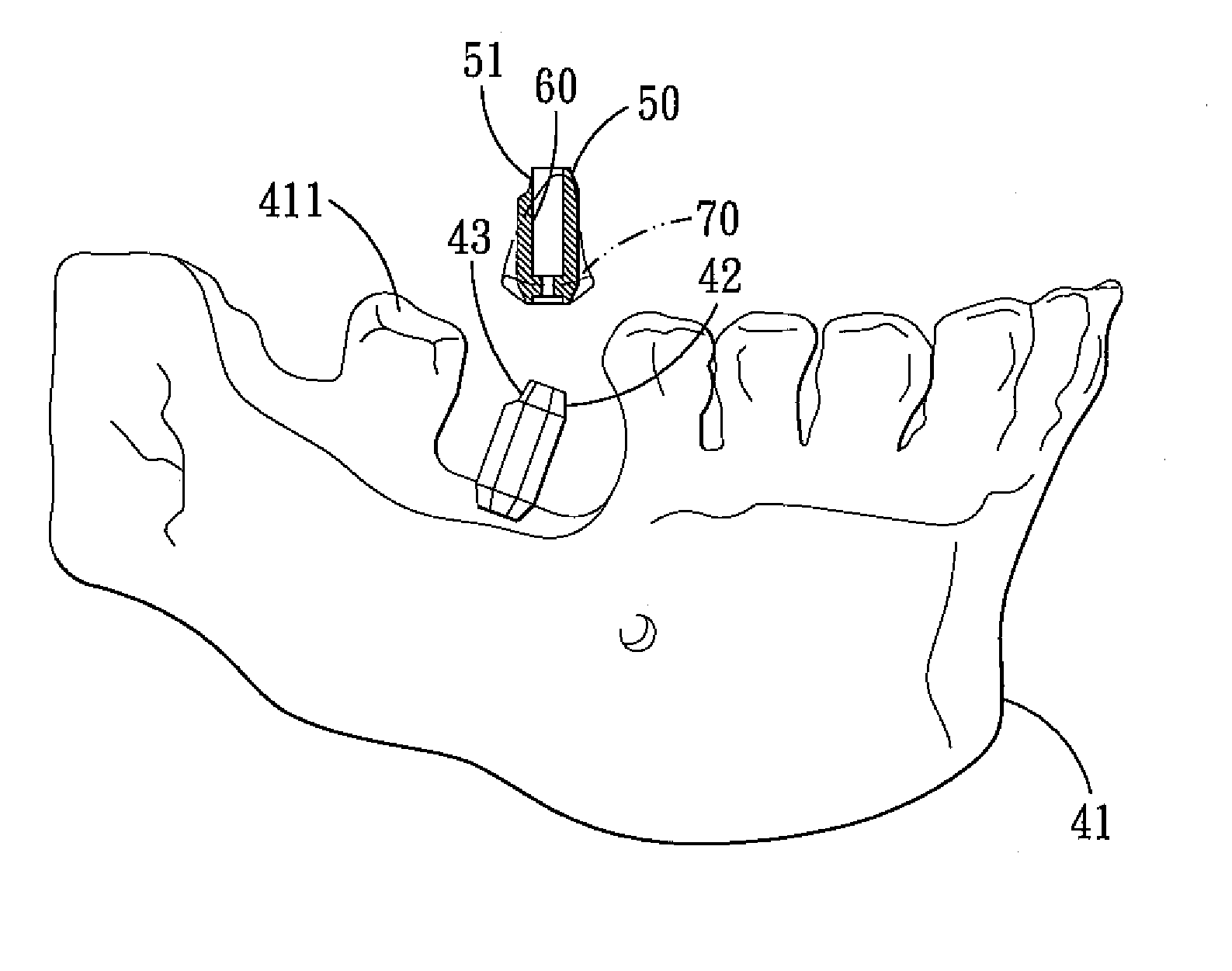 Method for designing an abutment