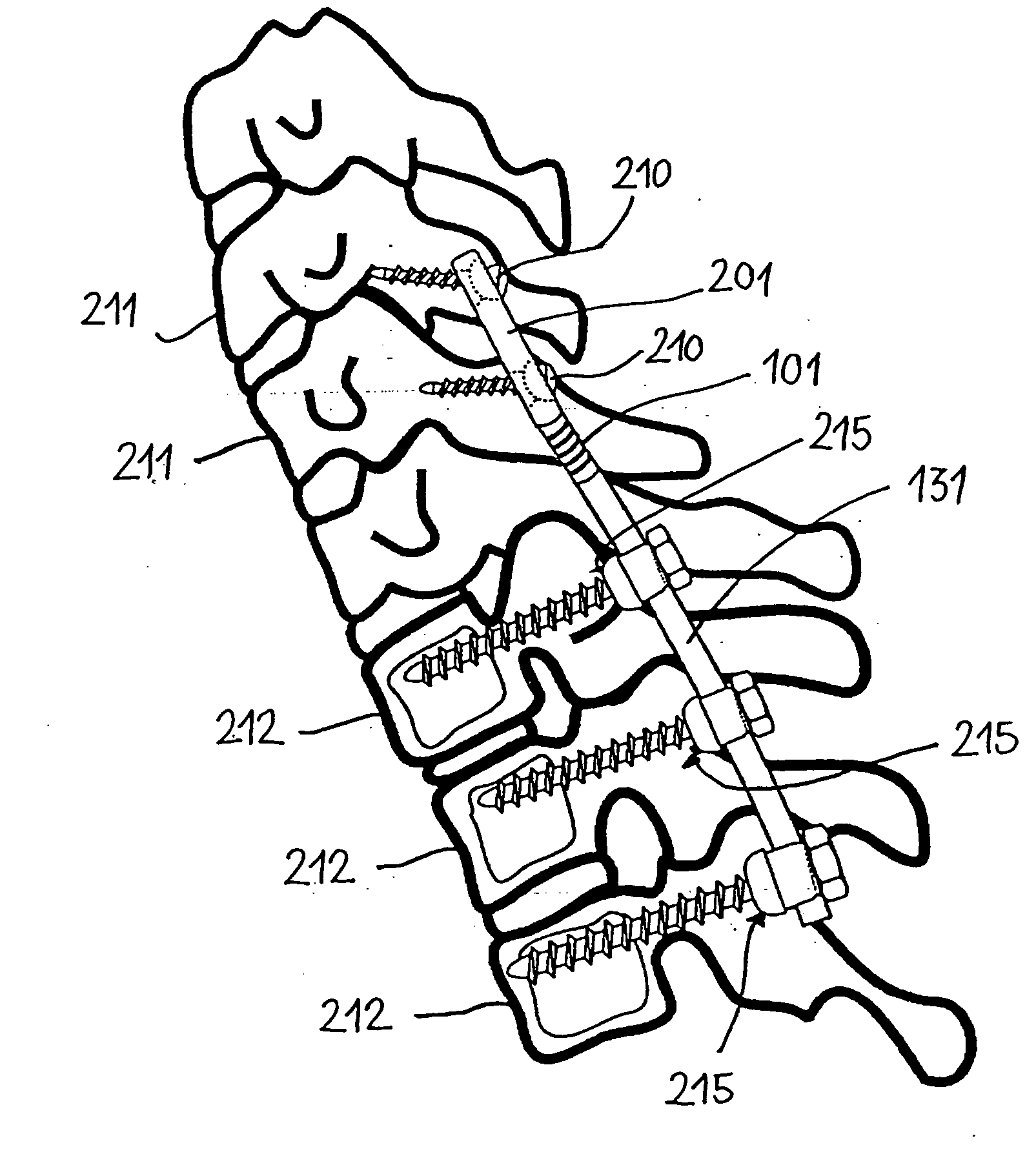 Stabilization device for bones comprising a spring element and manufacturing method for said spring element