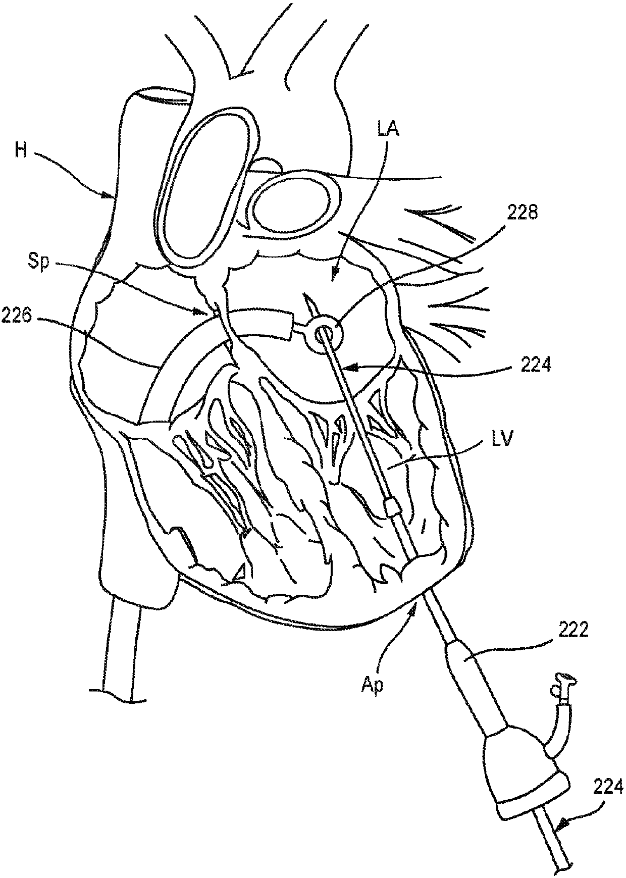 Apical control of transvascular delivery of prosthetic mitral valve
