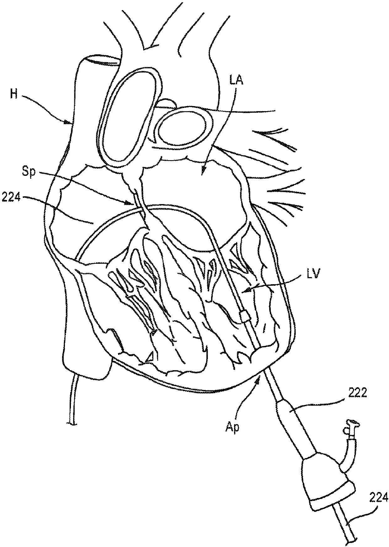 Apical control of transvascular delivery of prosthetic mitral valve