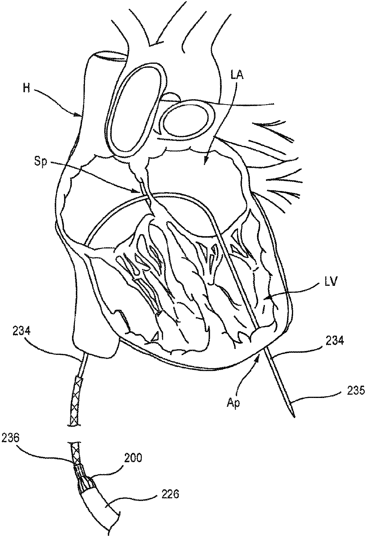 Apical control of transvascular delivery of prosthetic mitral valve