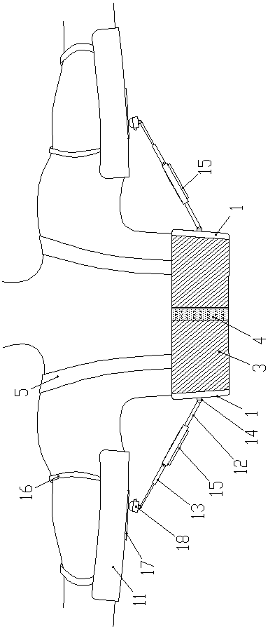 Bromhidrosis postoperative upper limb supporting device
