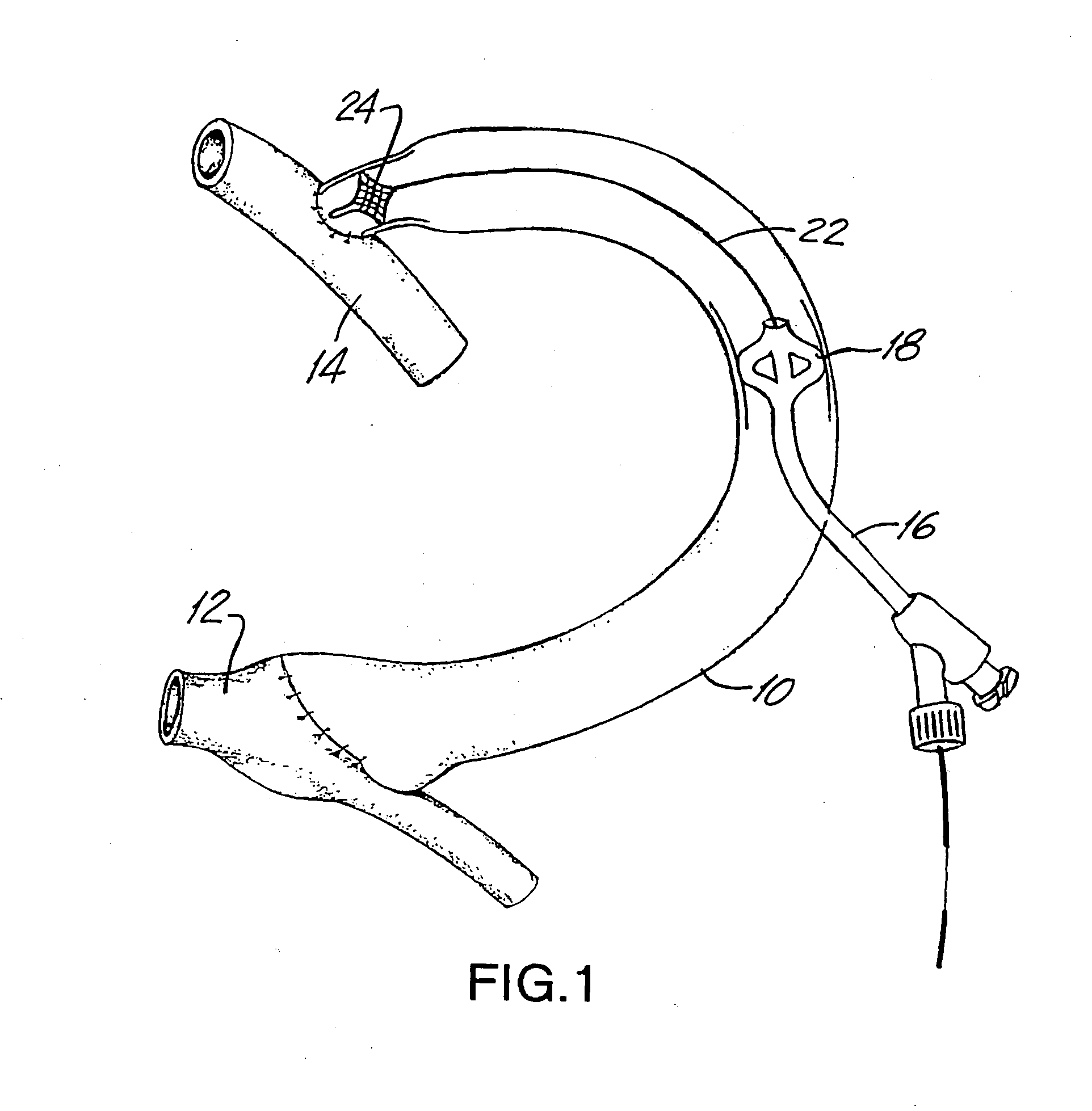 Method for treating a target site in a vascular body channel