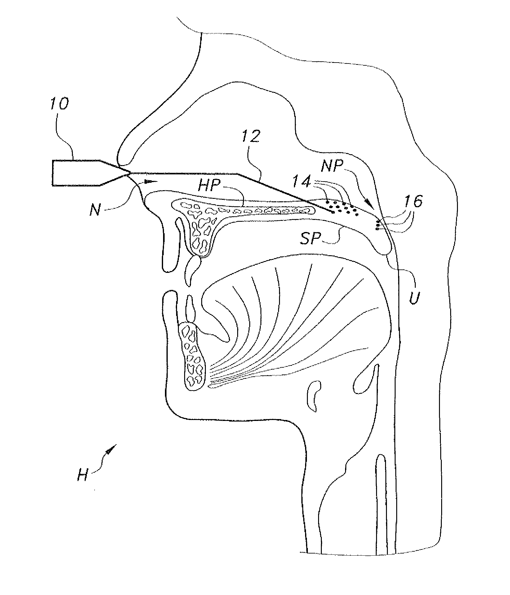 Endoscopic nasal palatoplasty