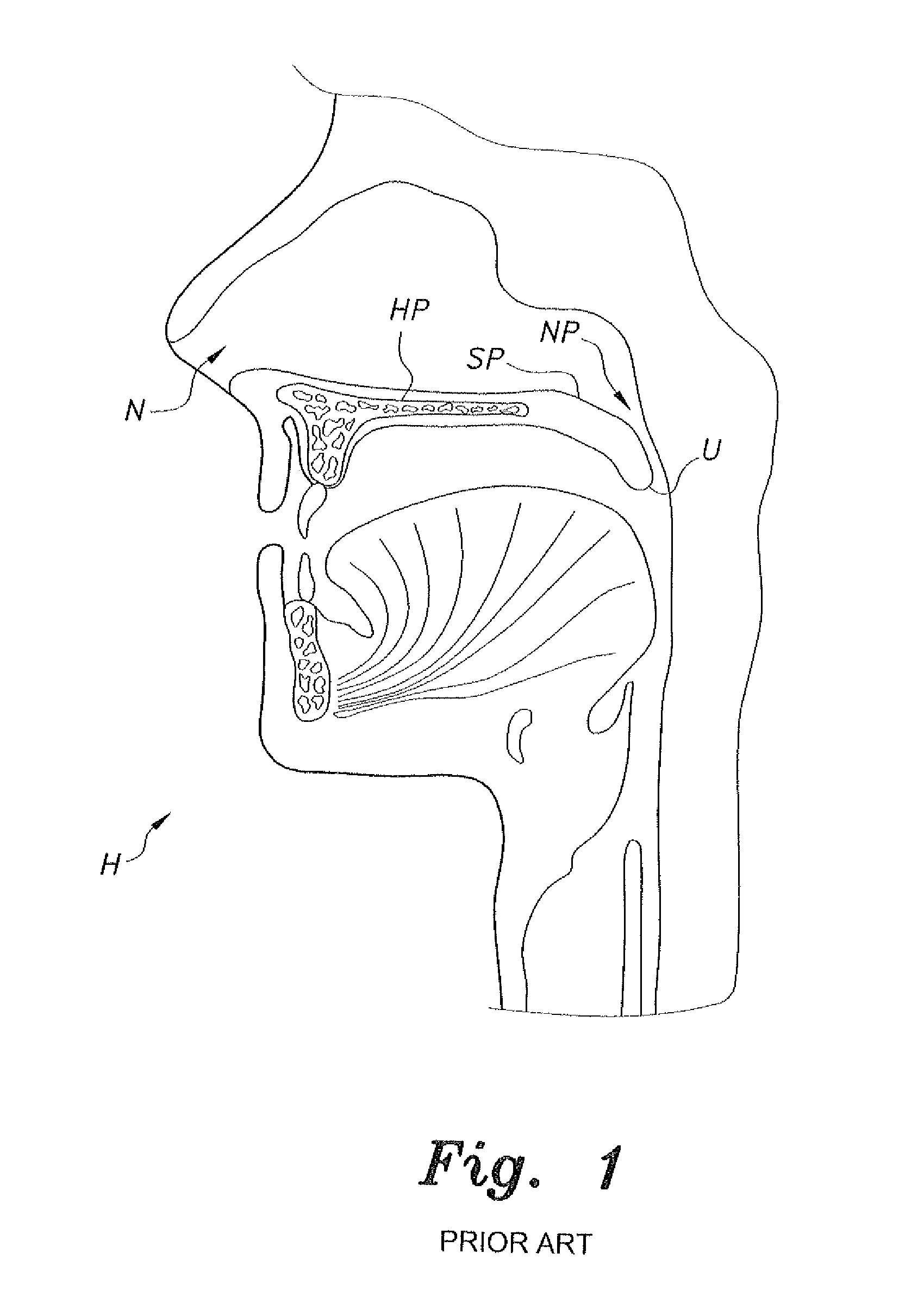 Endoscopic nasal palatoplasty