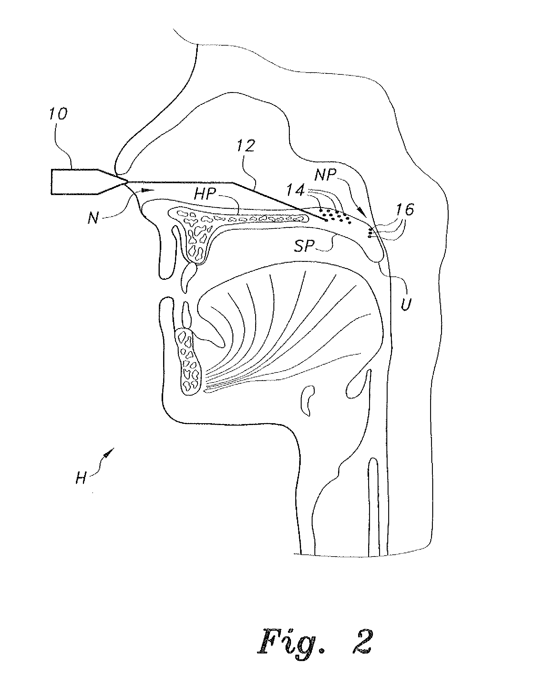 Endoscopic nasal palatoplasty