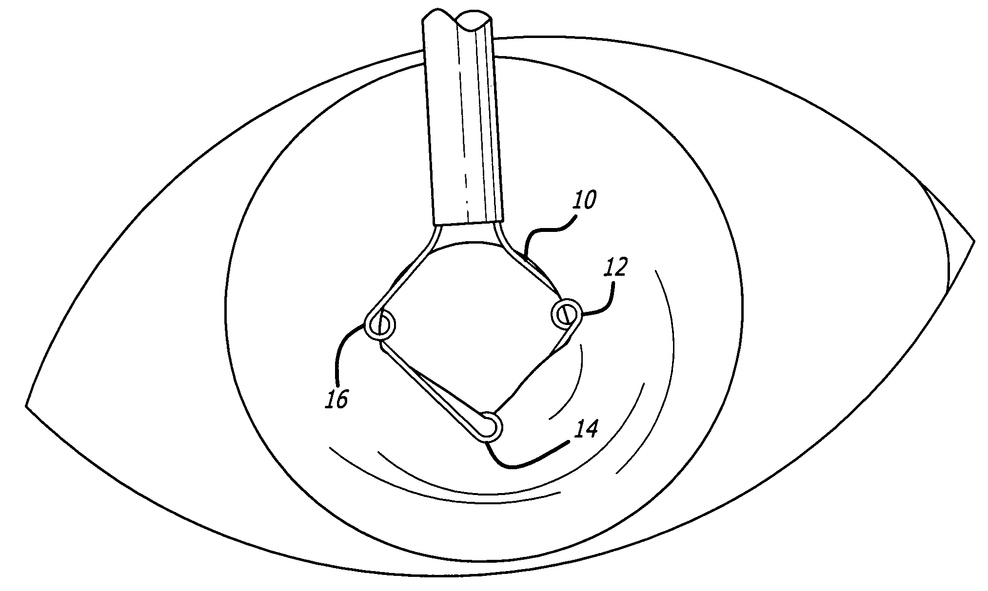 Ring used in a small pupil phacoemulsification procedure