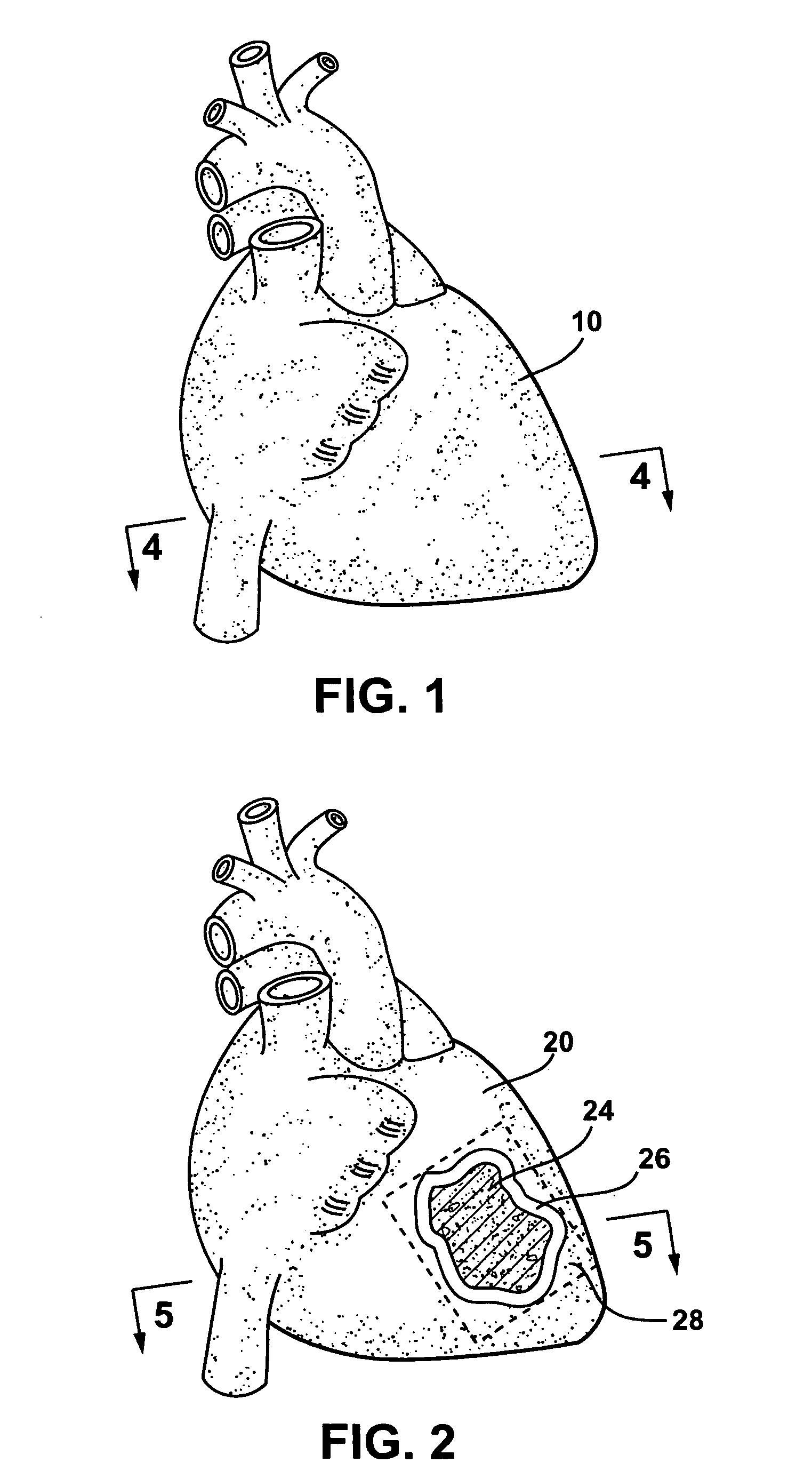 Methods and systems for treating injured cardiac tissue
