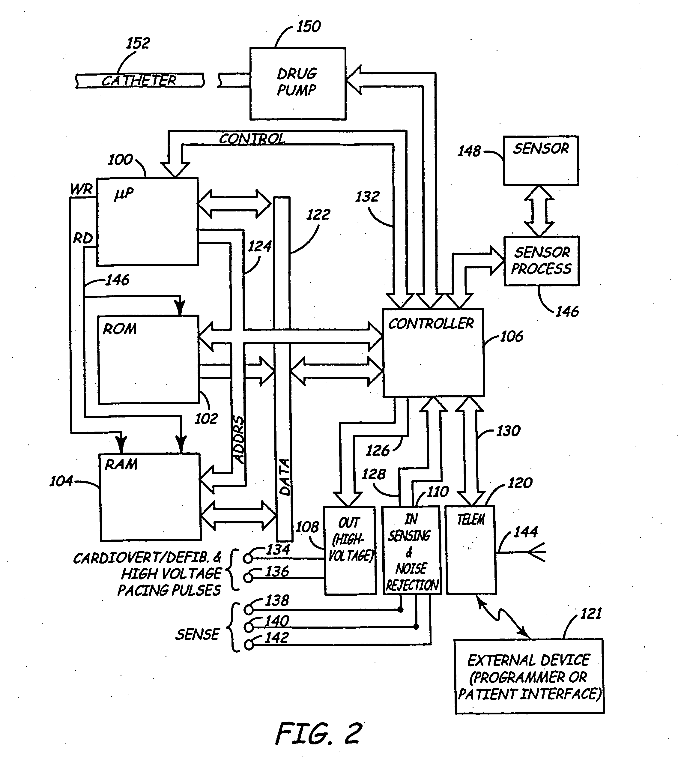 Apparatus for detecting and treating ventricular arrhythmia