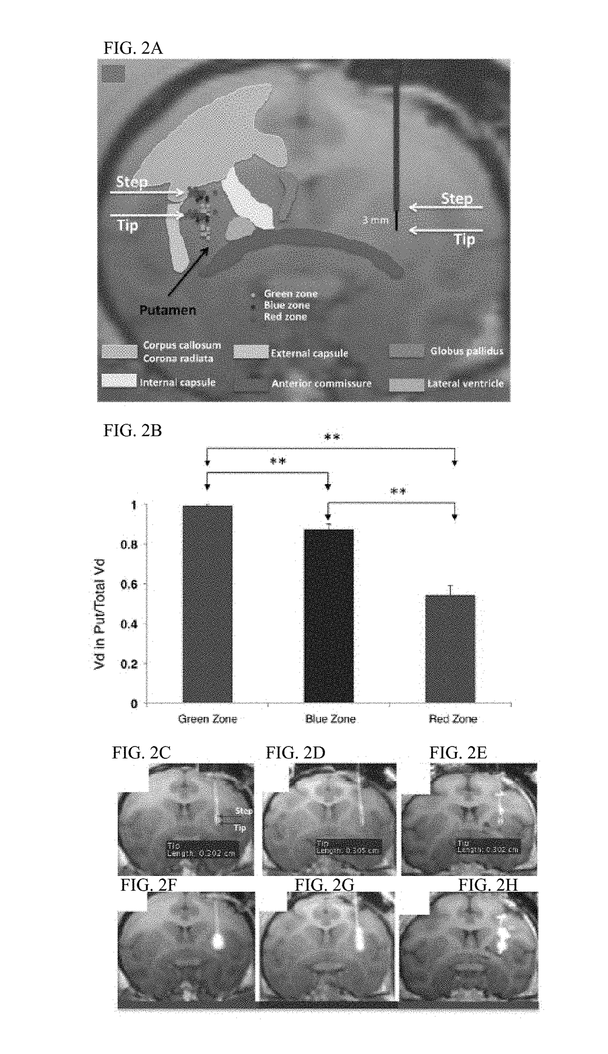 Optimized placement of cannula for delivery of therapeutics to the brain