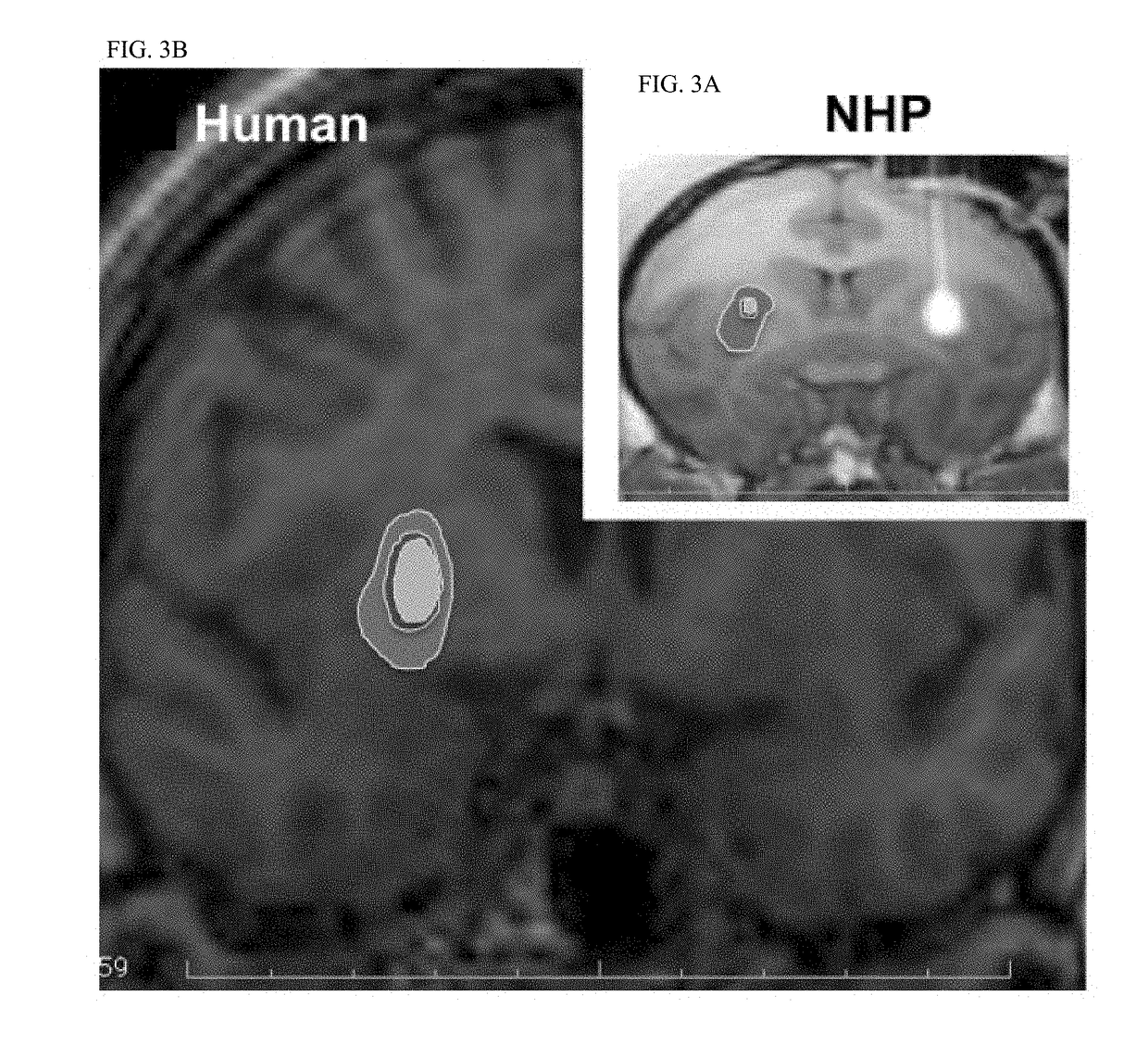 Optimized placement of cannula for delivery of therapeutics to the brain