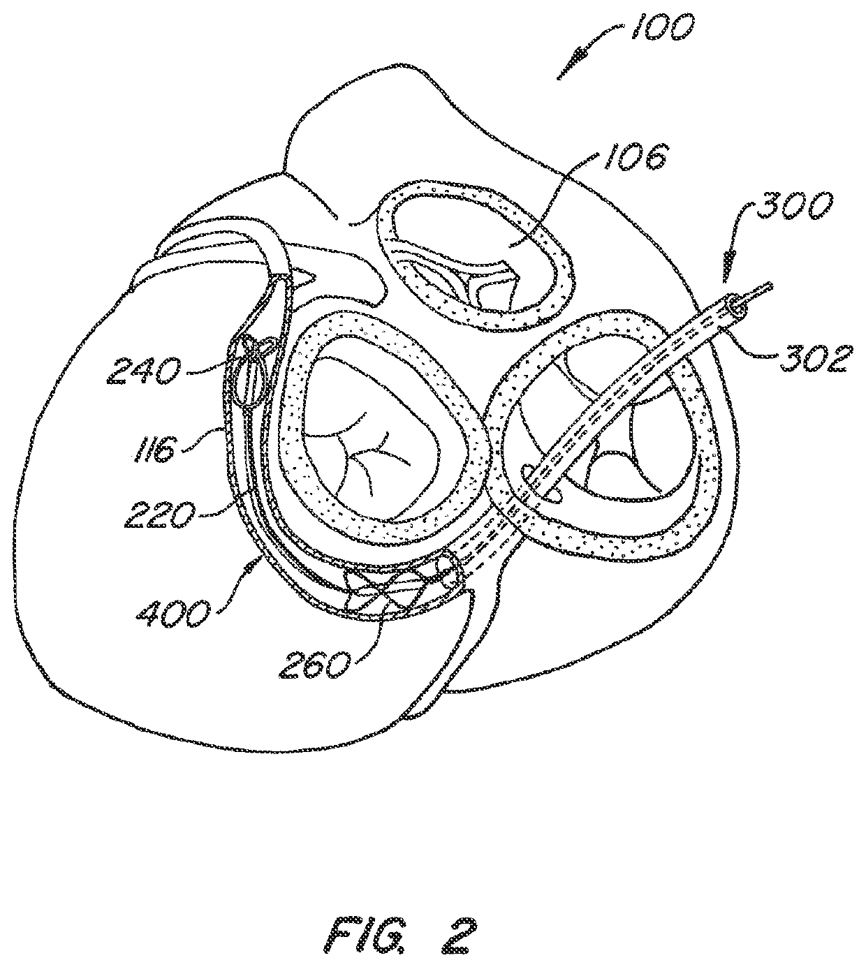 Mitral valve annuloplasty device with twisted anchor