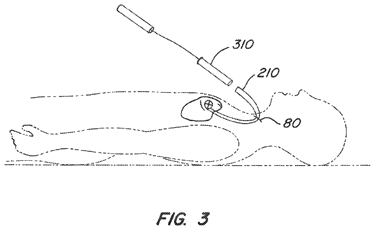 Mitral valve annuloplasty device with twisted anchor