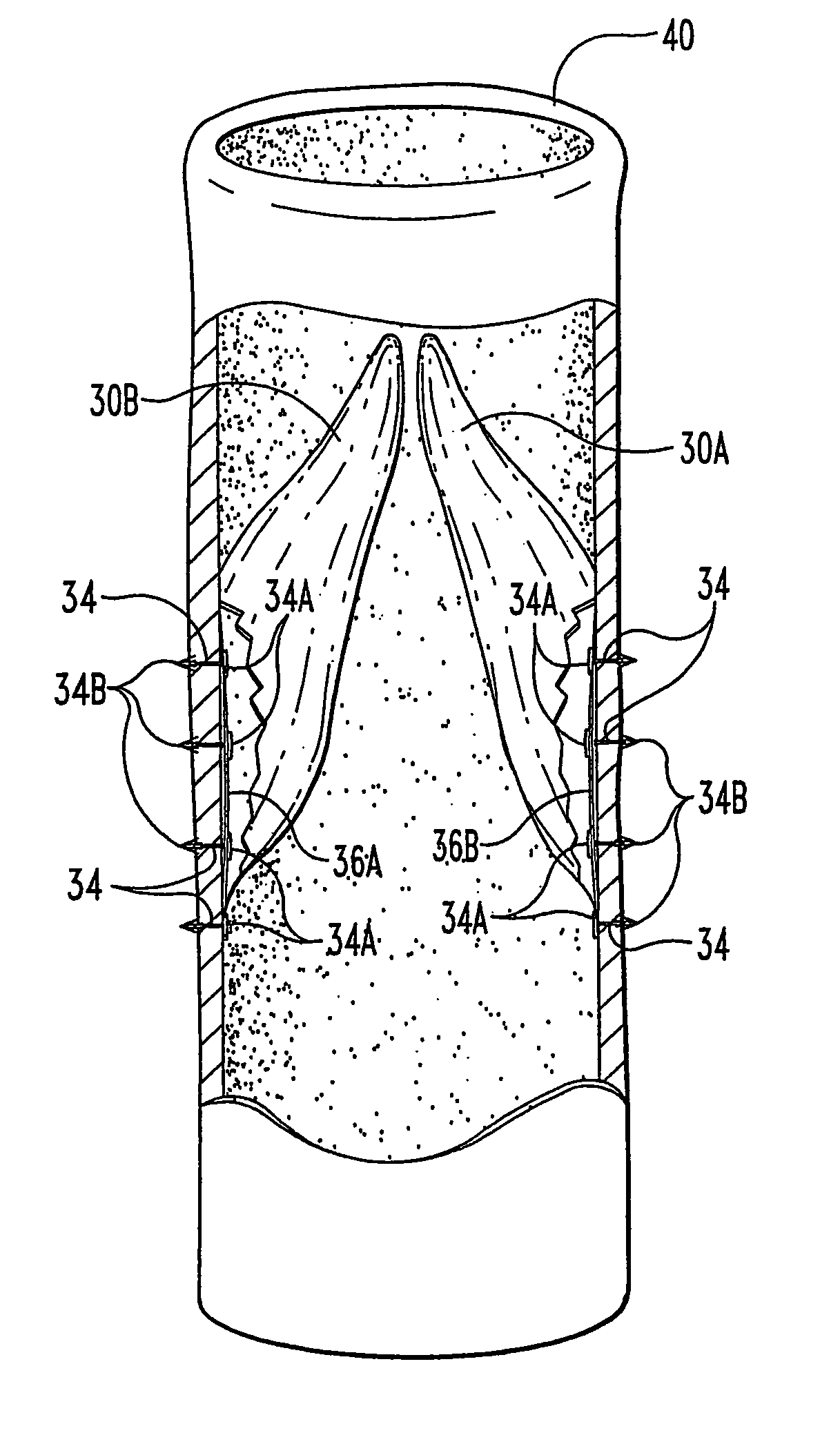 Methods and devices for the endoluminal deployment and securement of prostheses
