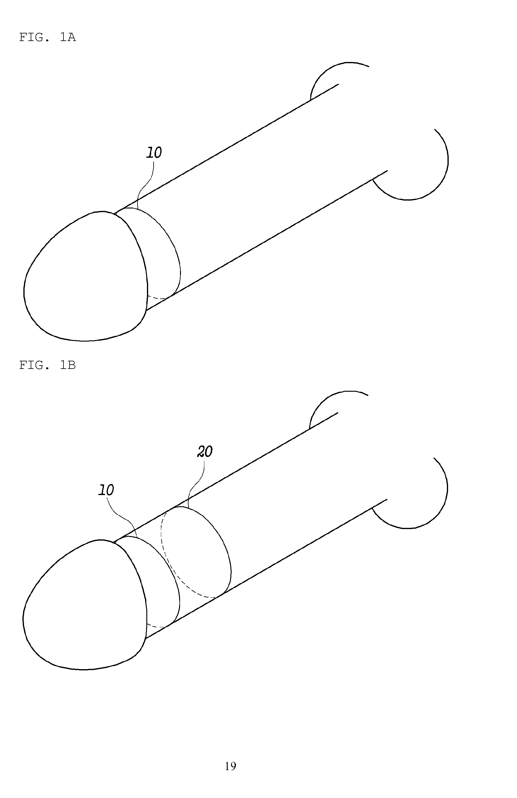 Method for complex phaloplasty using circumcised foreskin as autograft