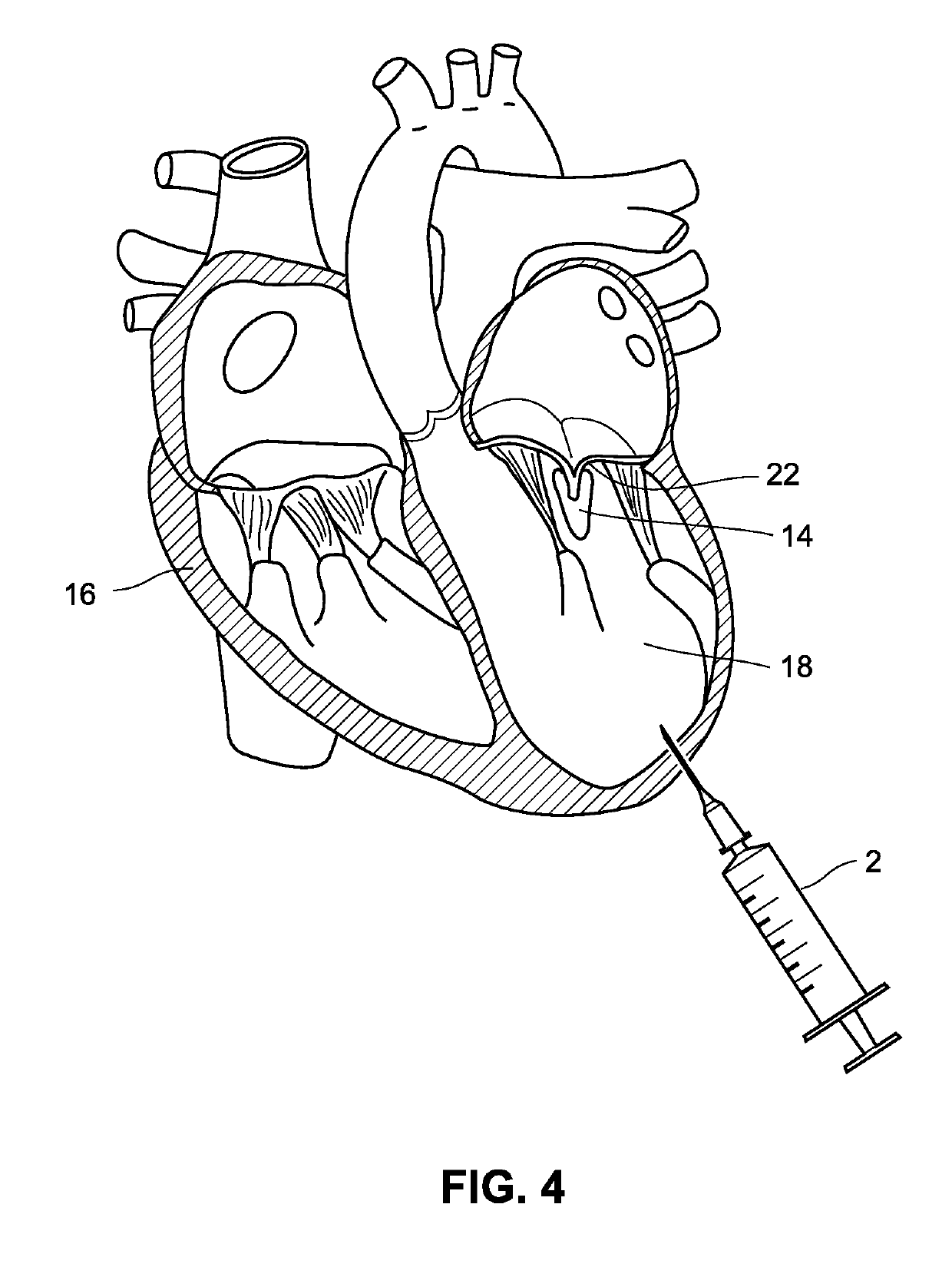 Transapical removal device