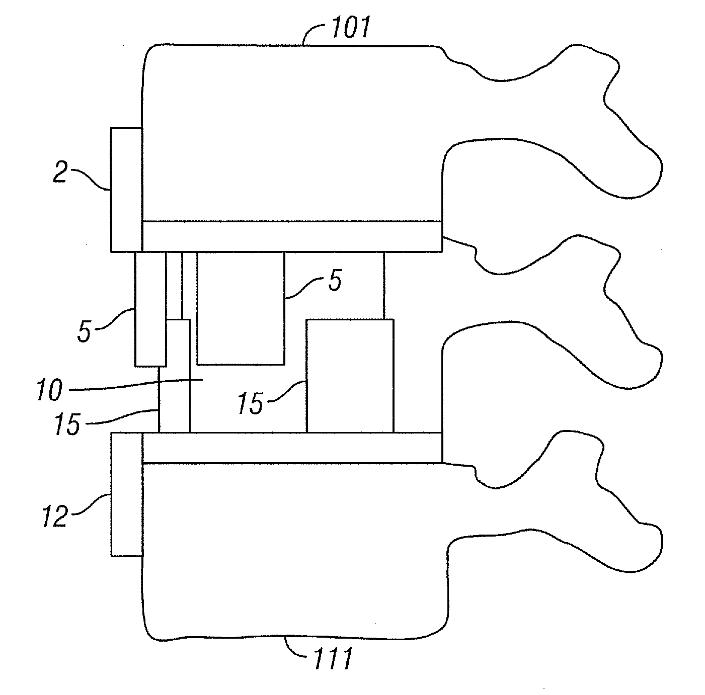 Device for Stabilizing a Vertebral Joint and Method for Anterior Insertion Thereof