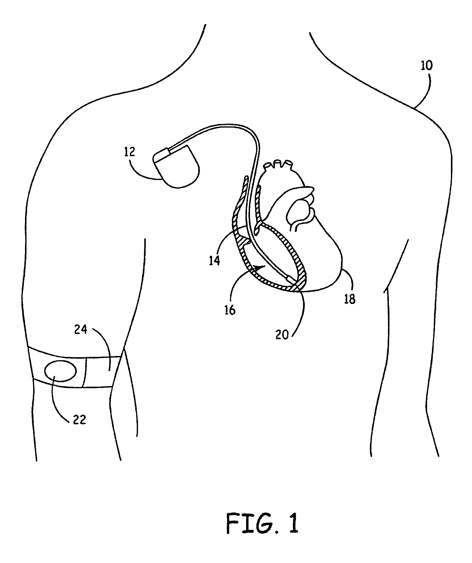 Fault tolerant implantable pulse generators and implantable cardioverter-defibrillators incorporating physiologic sensors and methods for implementing fault tolerance in same