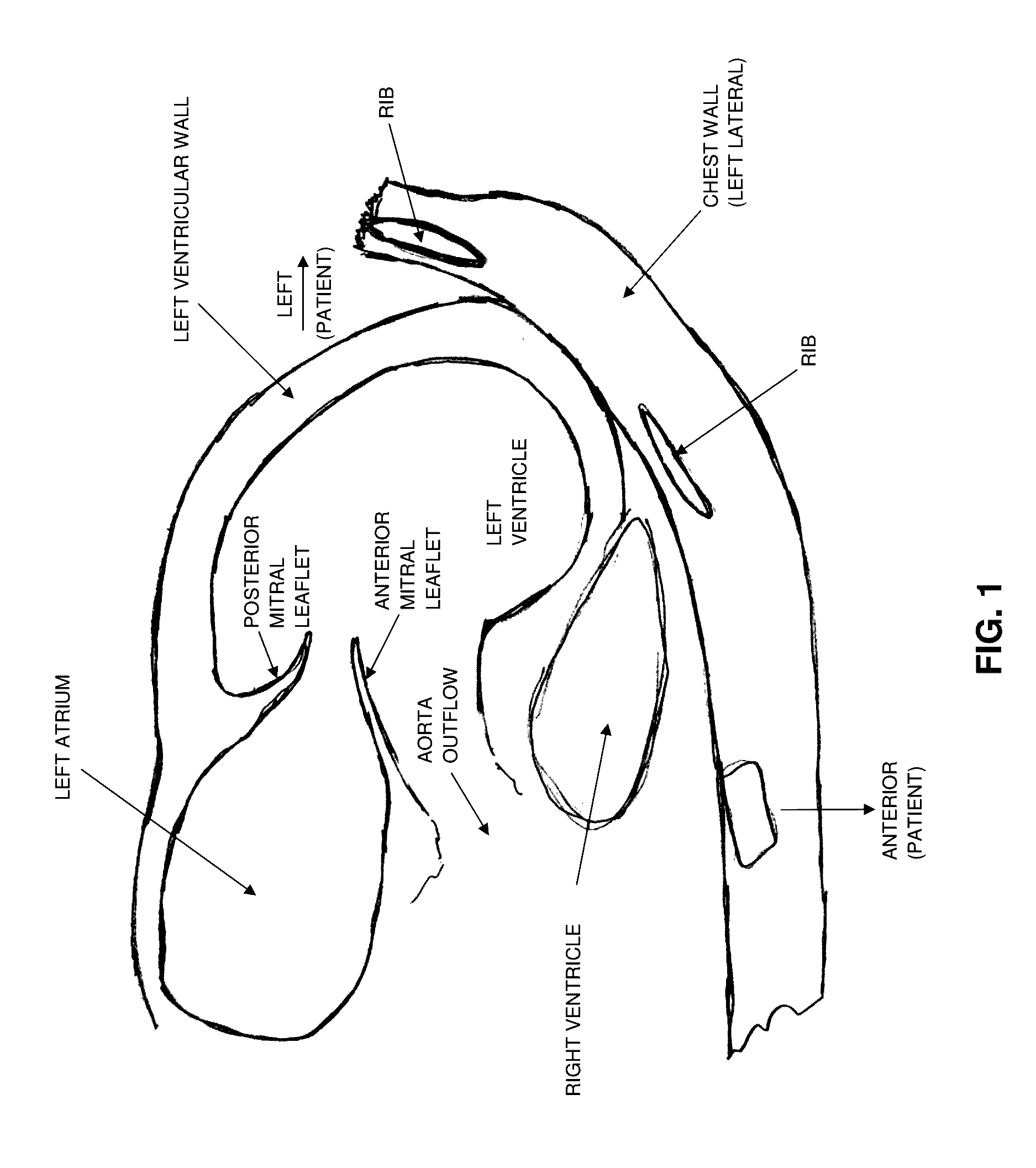 Method and apparatus for repairing a mitral valve
