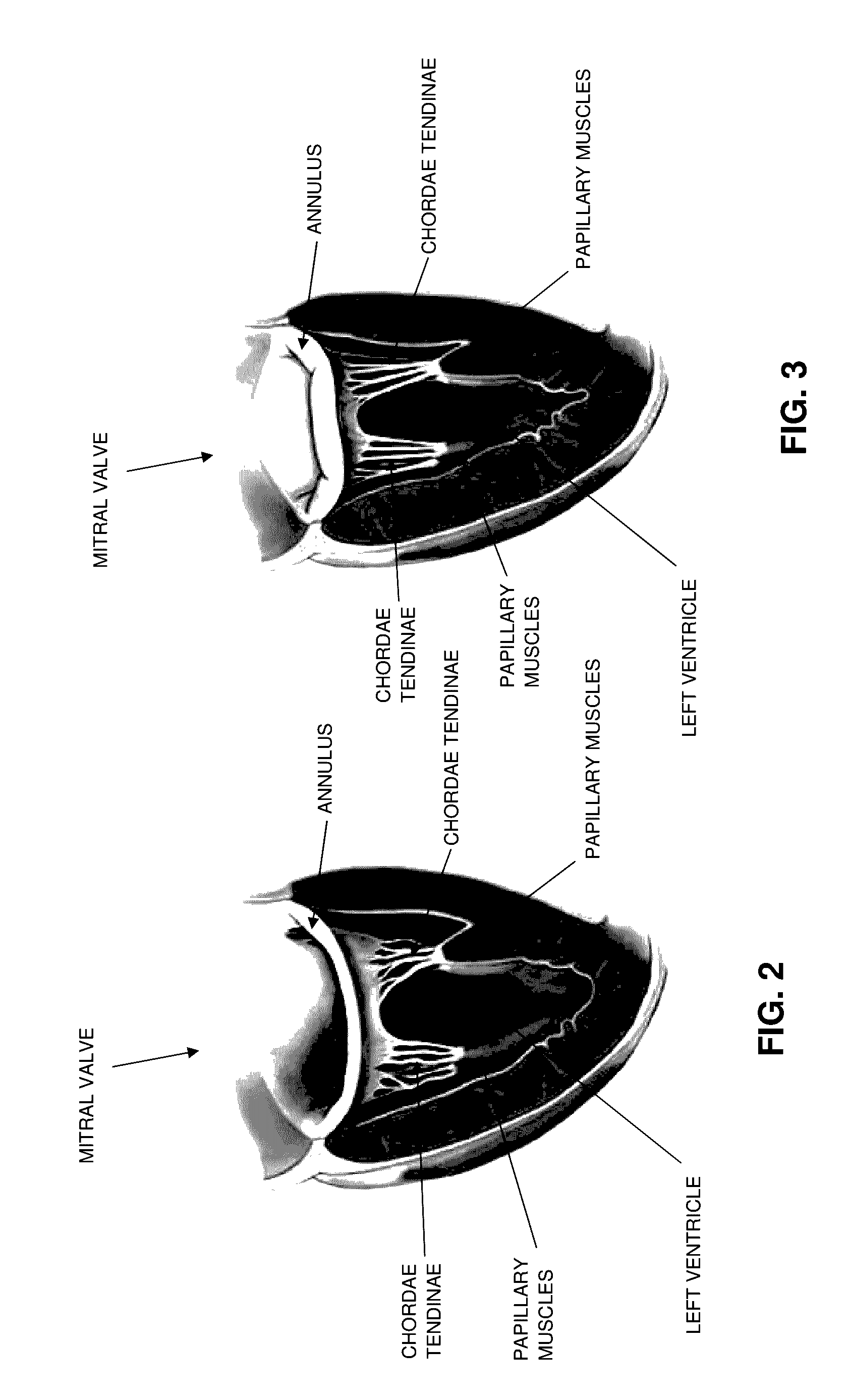 Method and apparatus for repairing a mitral valve