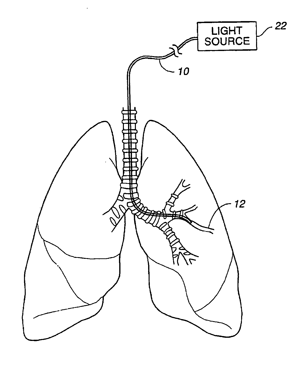Method of treating airways in the lung