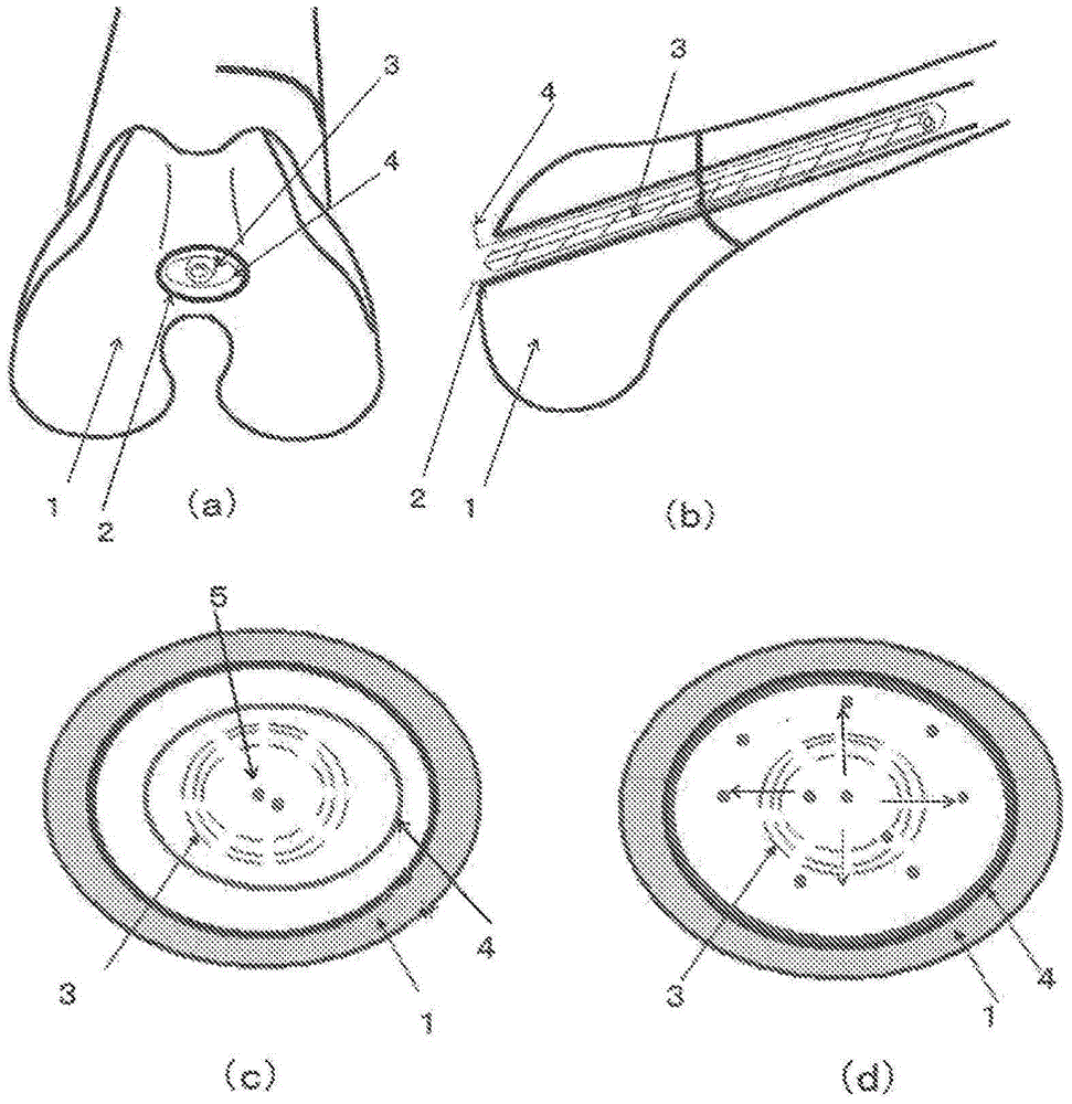 Three-dimensional structure made of material containing polyhydroxyalkanoate, kit for preparation of bone filling material, and intramedullary nail