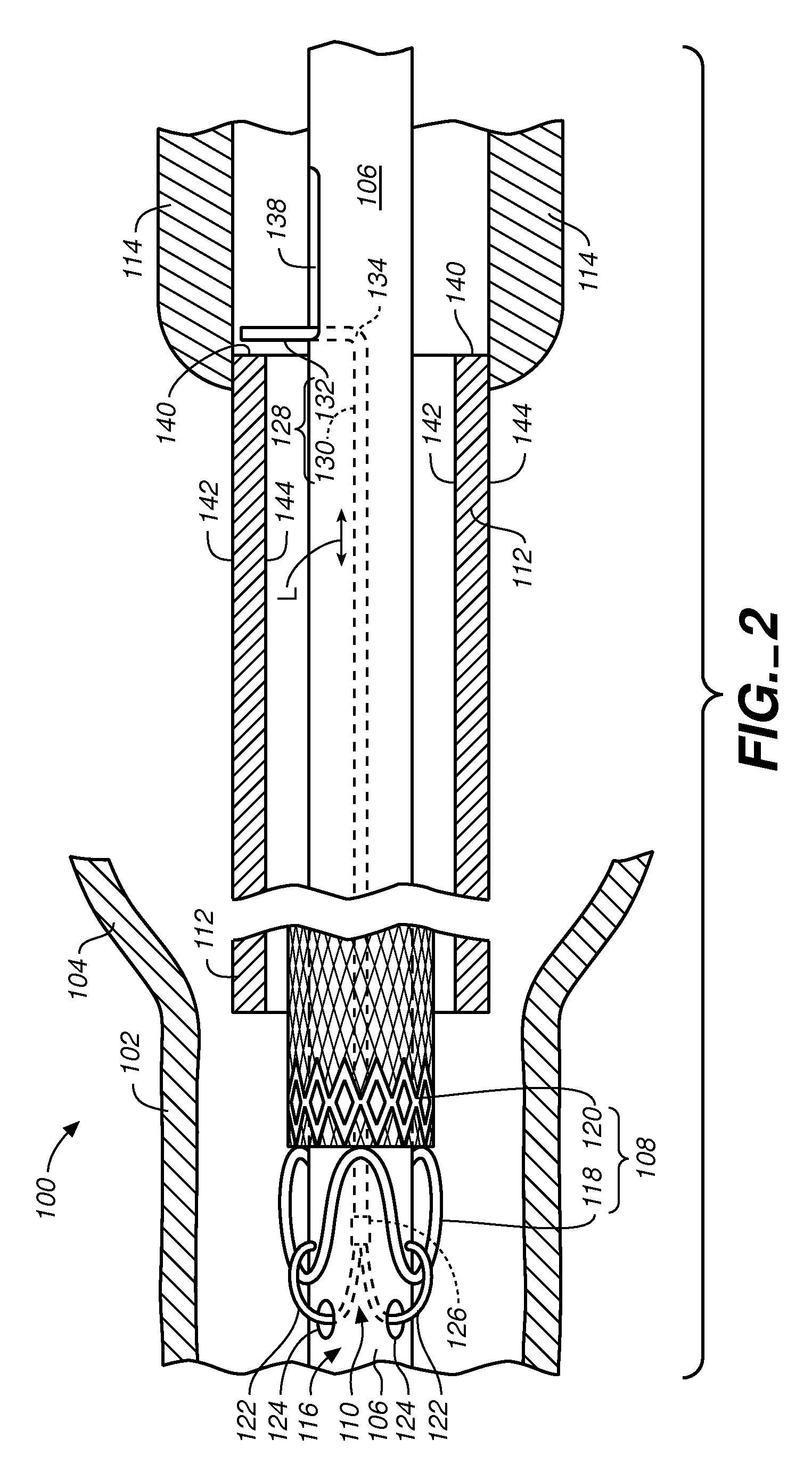 Stent-graft delivery system