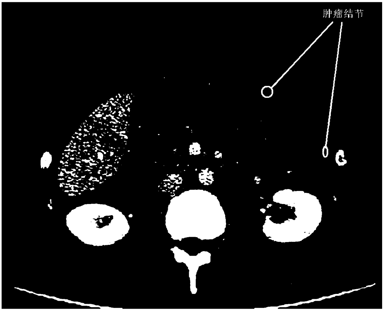 Abdominal cavity CT image peritoneal metastasis marking method based on deep convolutional neural network