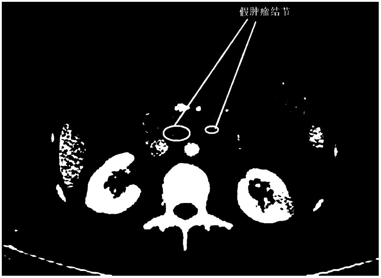 Abdominal cavity CT image peritoneal metastasis marking method based on deep convolutional neural network