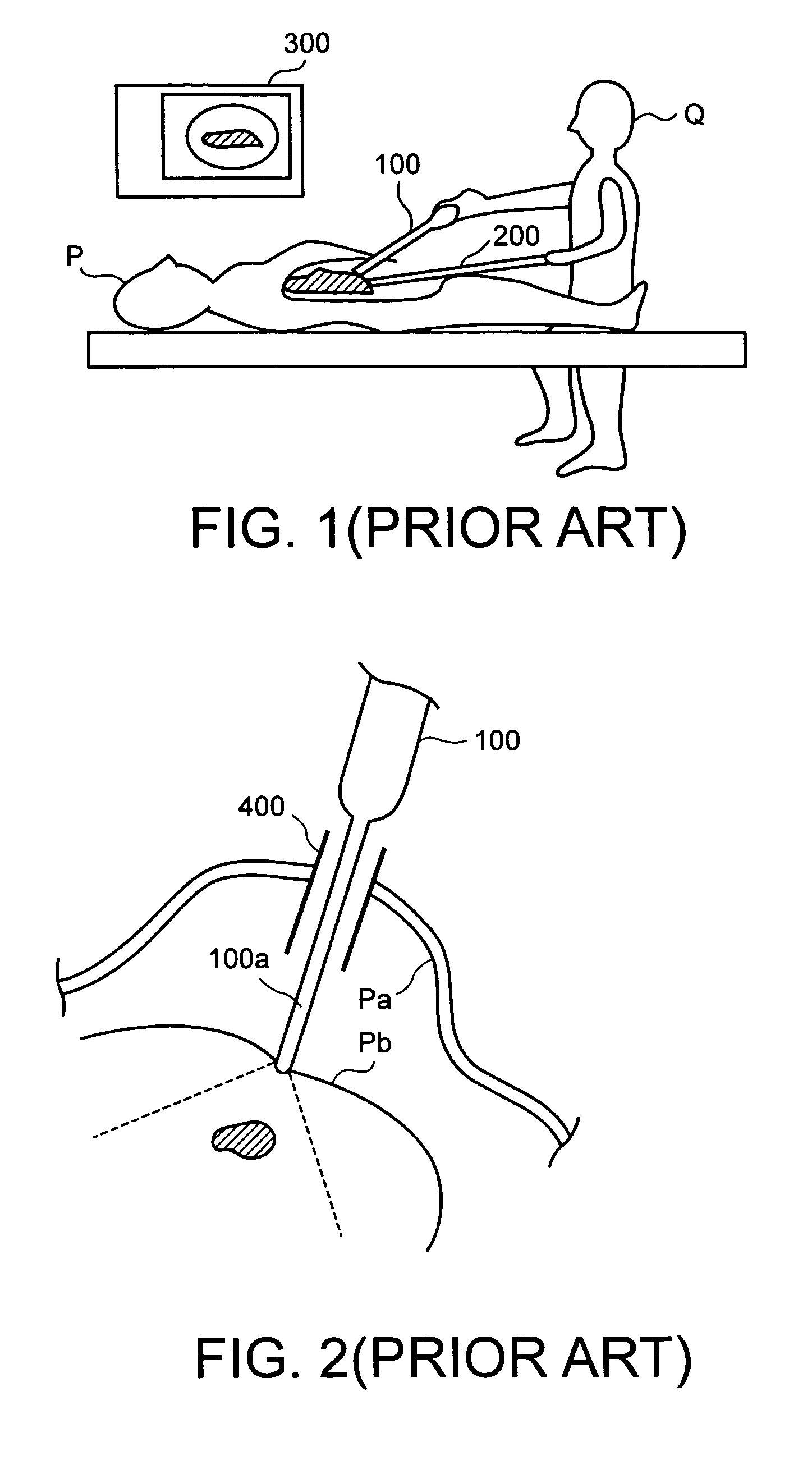 Ultrasonic endocavity probe having adjustable length insert