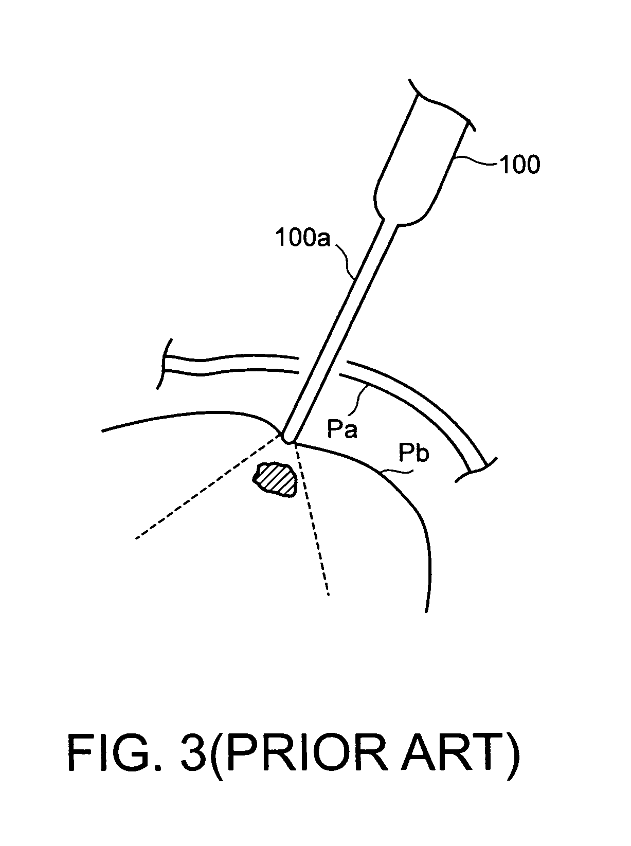 Ultrasonic endocavity probe having adjustable length insert