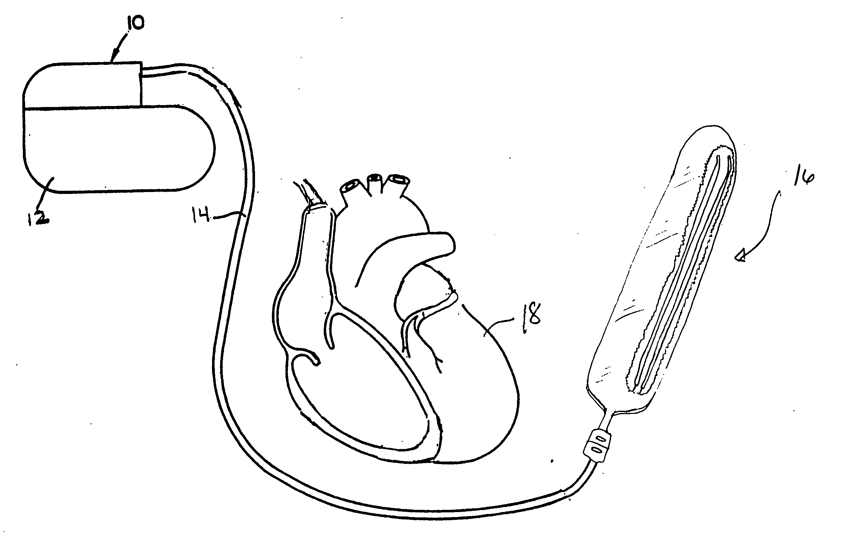 Subcutaneous lead system for detection and treatment of malignant ventricular arrhythmia