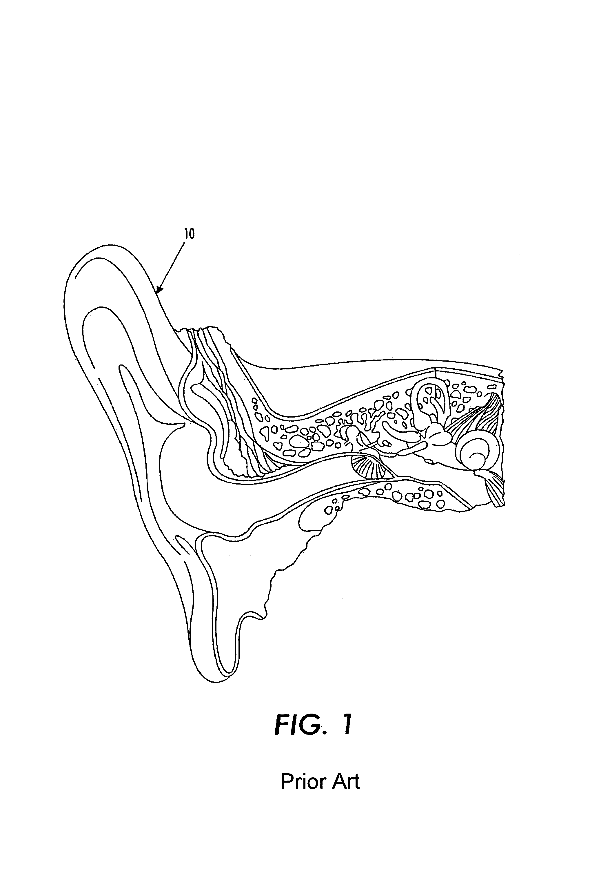 In the ear hearing aid utilizing annular ring acoustic seals