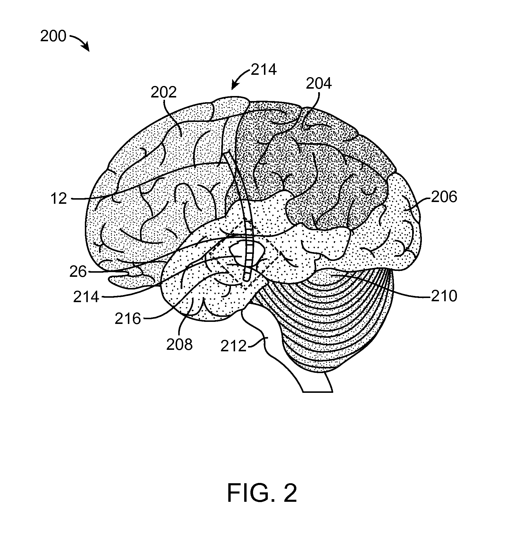 Methods and apparatus for treating glioma