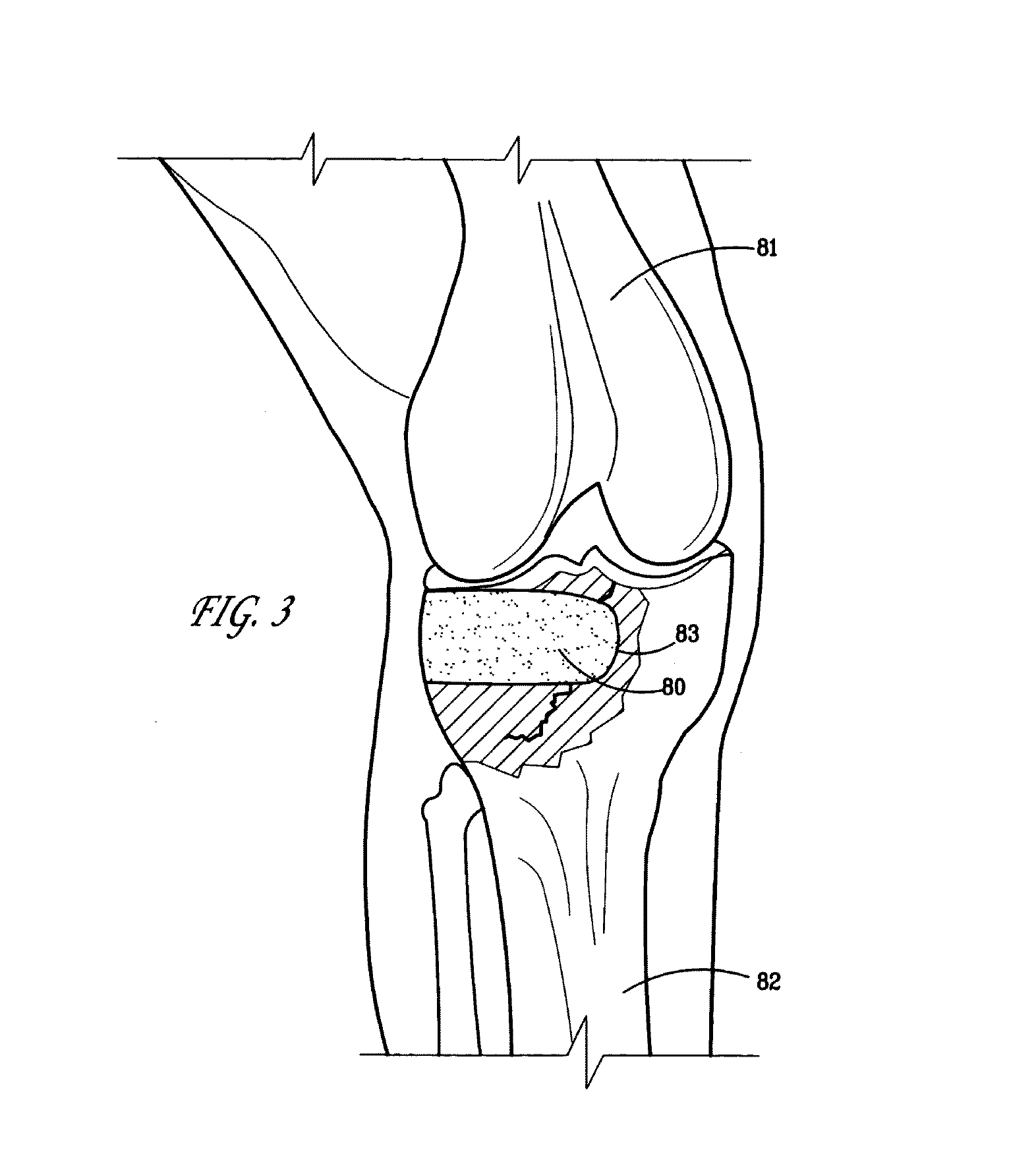 Bioactive flowable wash-out resistant bone graft material and method for production thereof