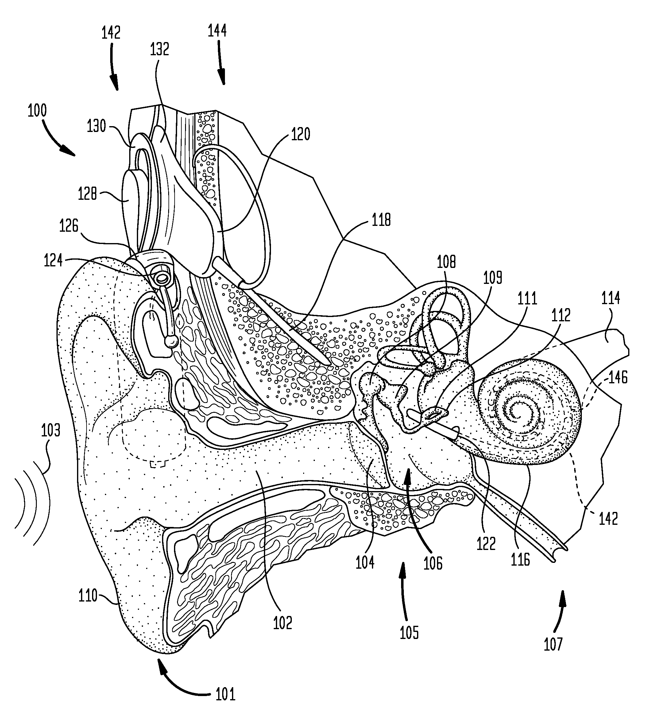 Provision of stimulus components having variable perceptability to stimulating device recipient