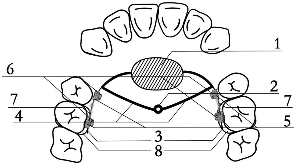 Nanoce arch orthodontic molar control device