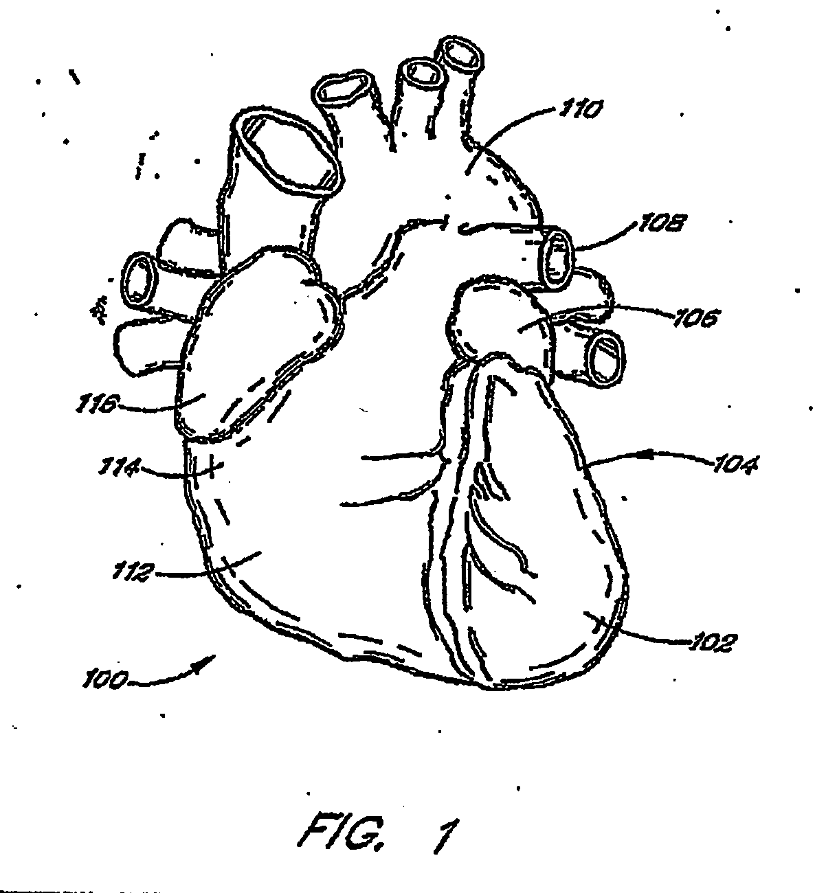 Devices and methods for closing a patent foramen ovale using a countertraction element