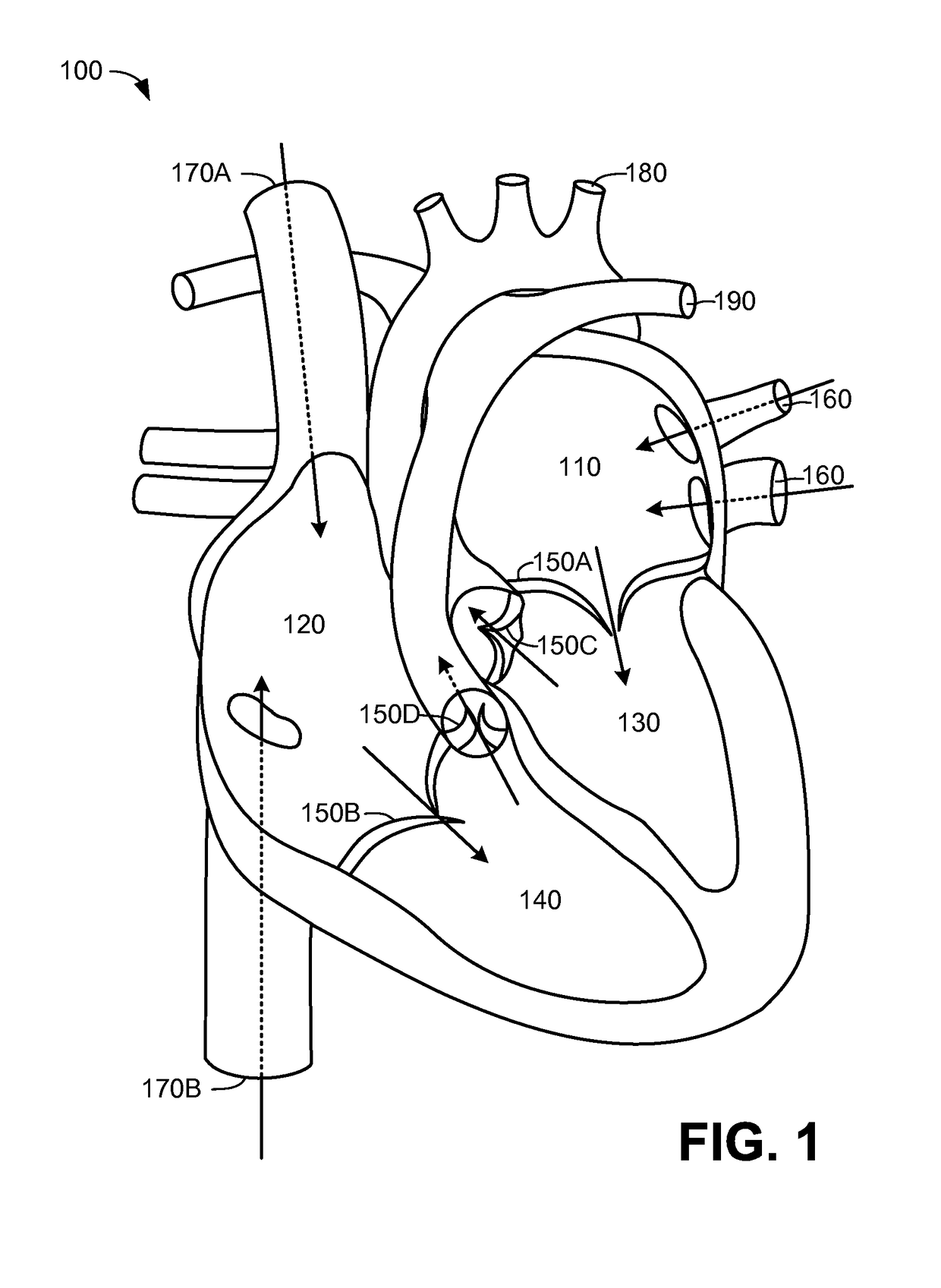Trileaflet Mechanical Prosthetic Heart Valve